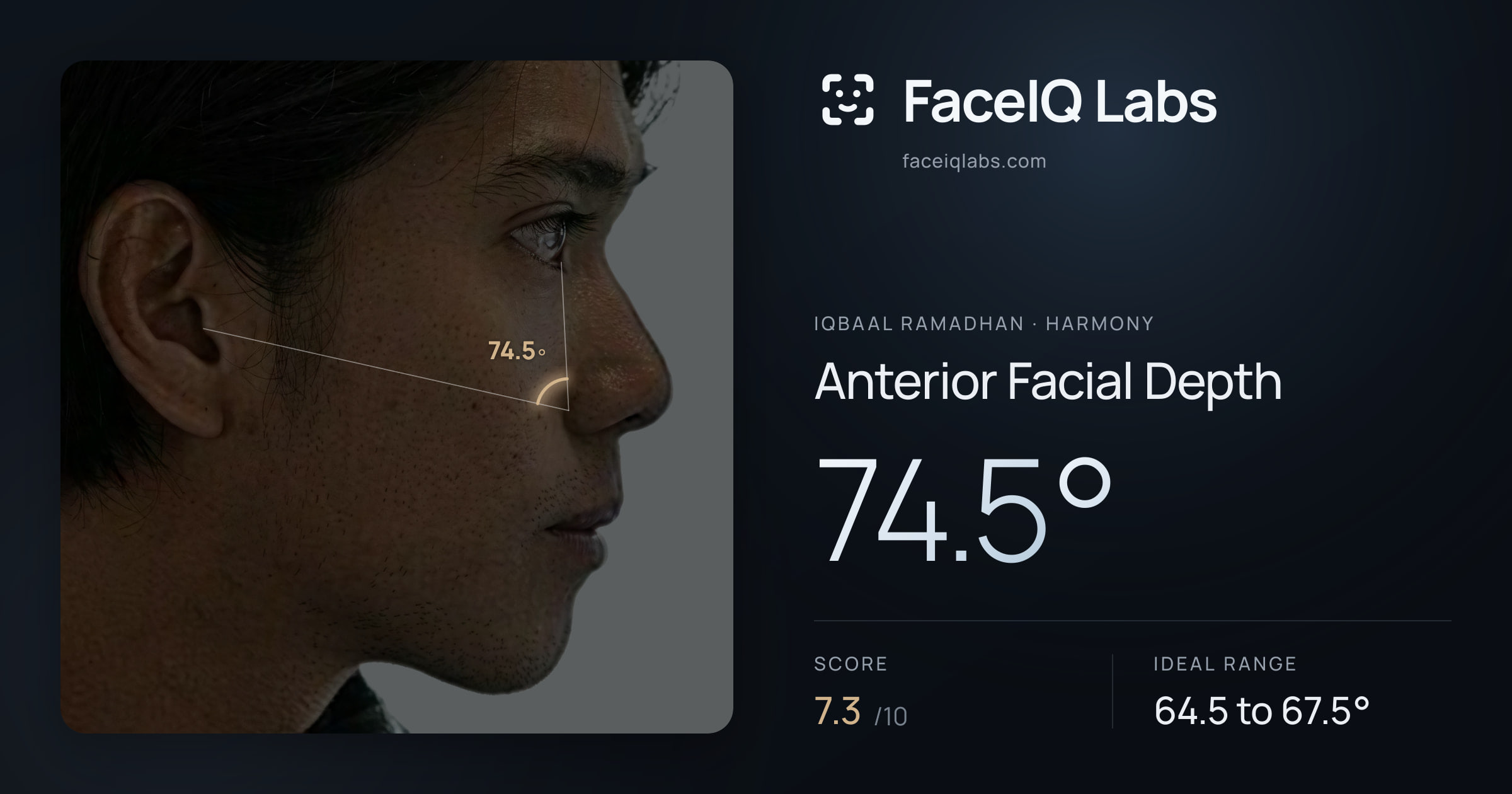 Iqbaal Ramadhan Anterior Facial Depth: 74.5°, drawn on the photo