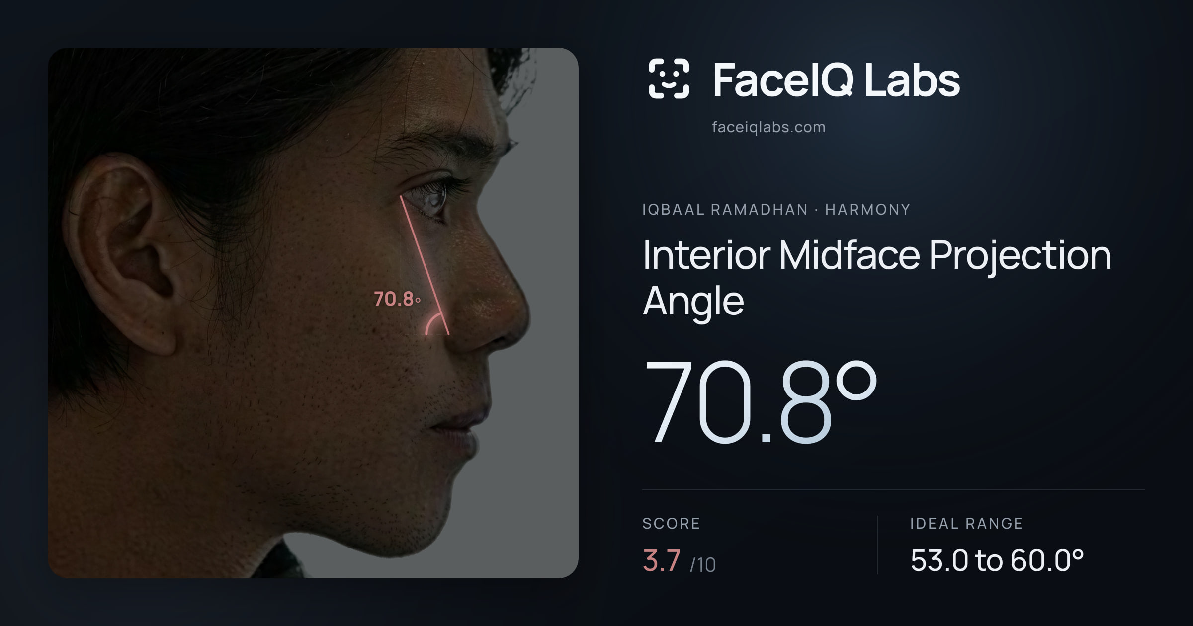 Iqbaal Ramadhan Interior Midface Projection Angle: 70.8°, drawn on the photo