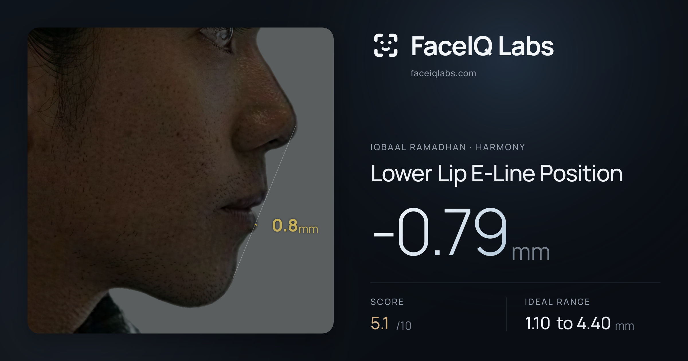Iqbaal Ramadhan Lower Lip E-Line Position: -0.79mm, drawn on the photo