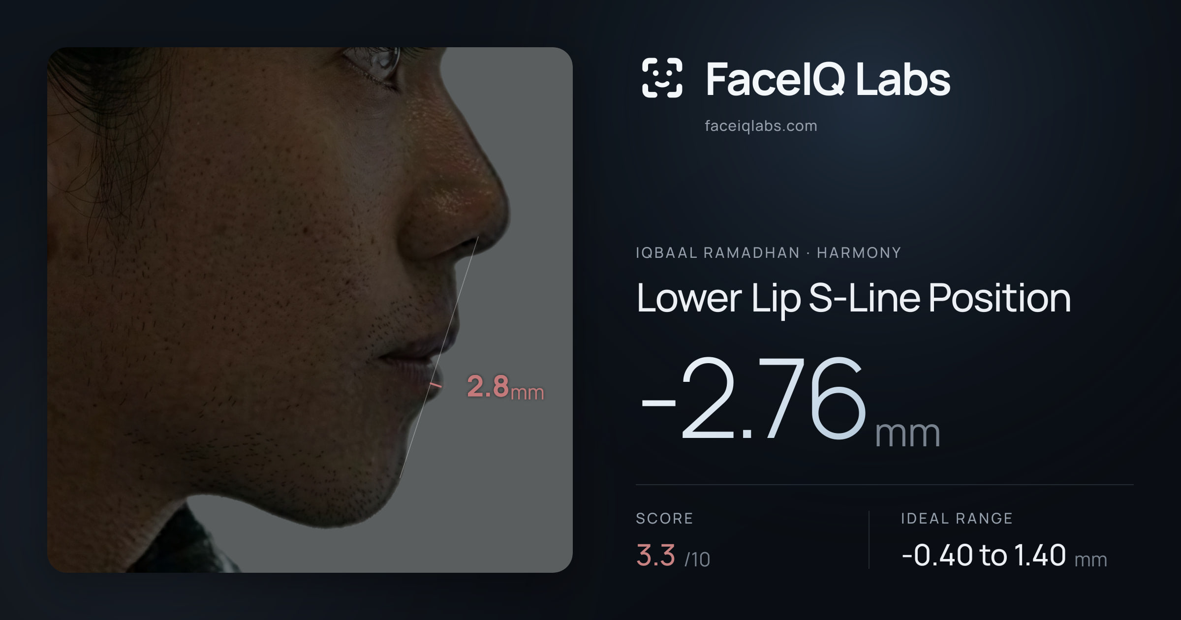 Iqbaal Ramadhan Lower Lip S-Line Position: -2.76mm, drawn on the photo