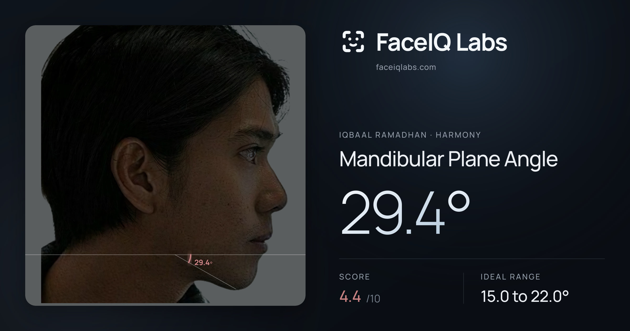 Iqbaal Ramadhan Mandibular Plane Angle: 29.4°, drawn on the photo