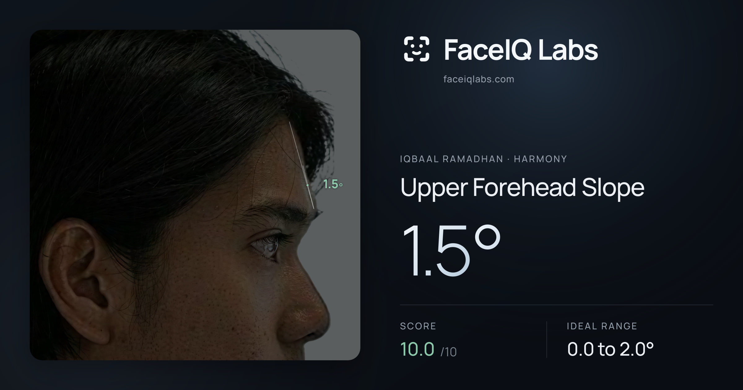 Iqbaal Ramadhan Upper Forehead Slope: 1.5°, drawn on the photo