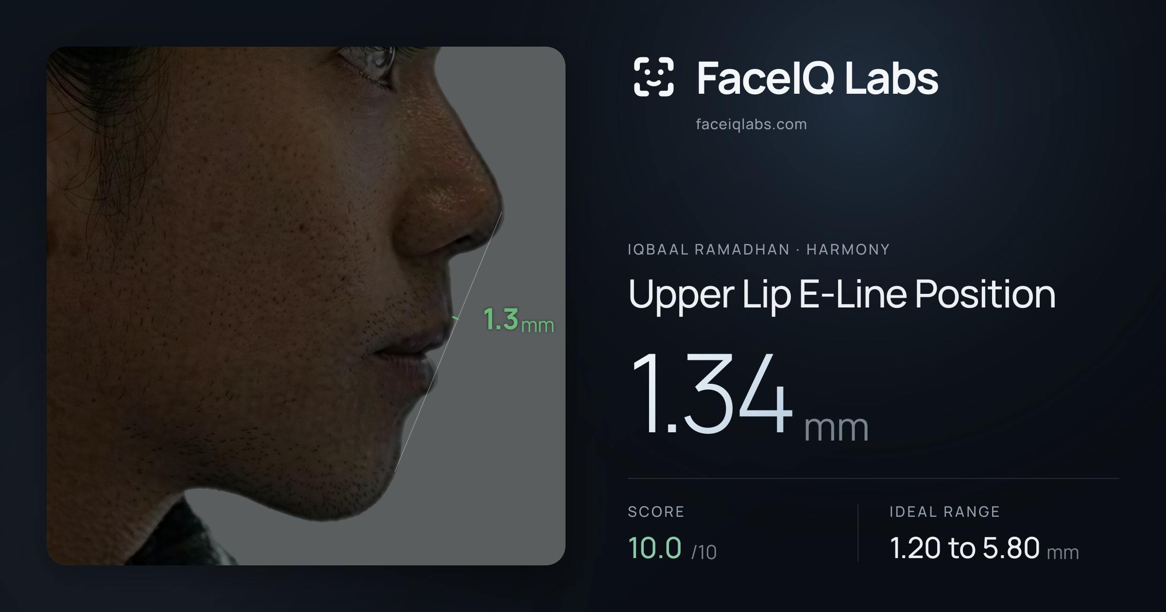 Iqbaal Ramadhan Upper Lip E-Line Position: 1.34mm, drawn on the photo