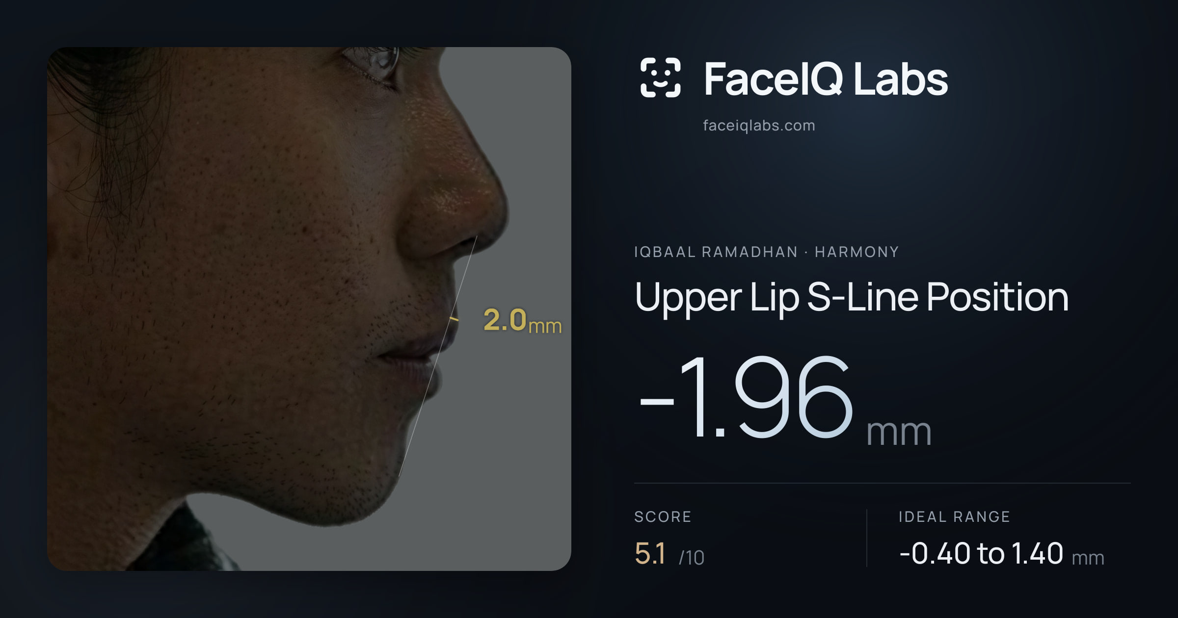 Iqbaal Ramadhan Upper Lip S-Line Position: -1.96mm, drawn on the photo