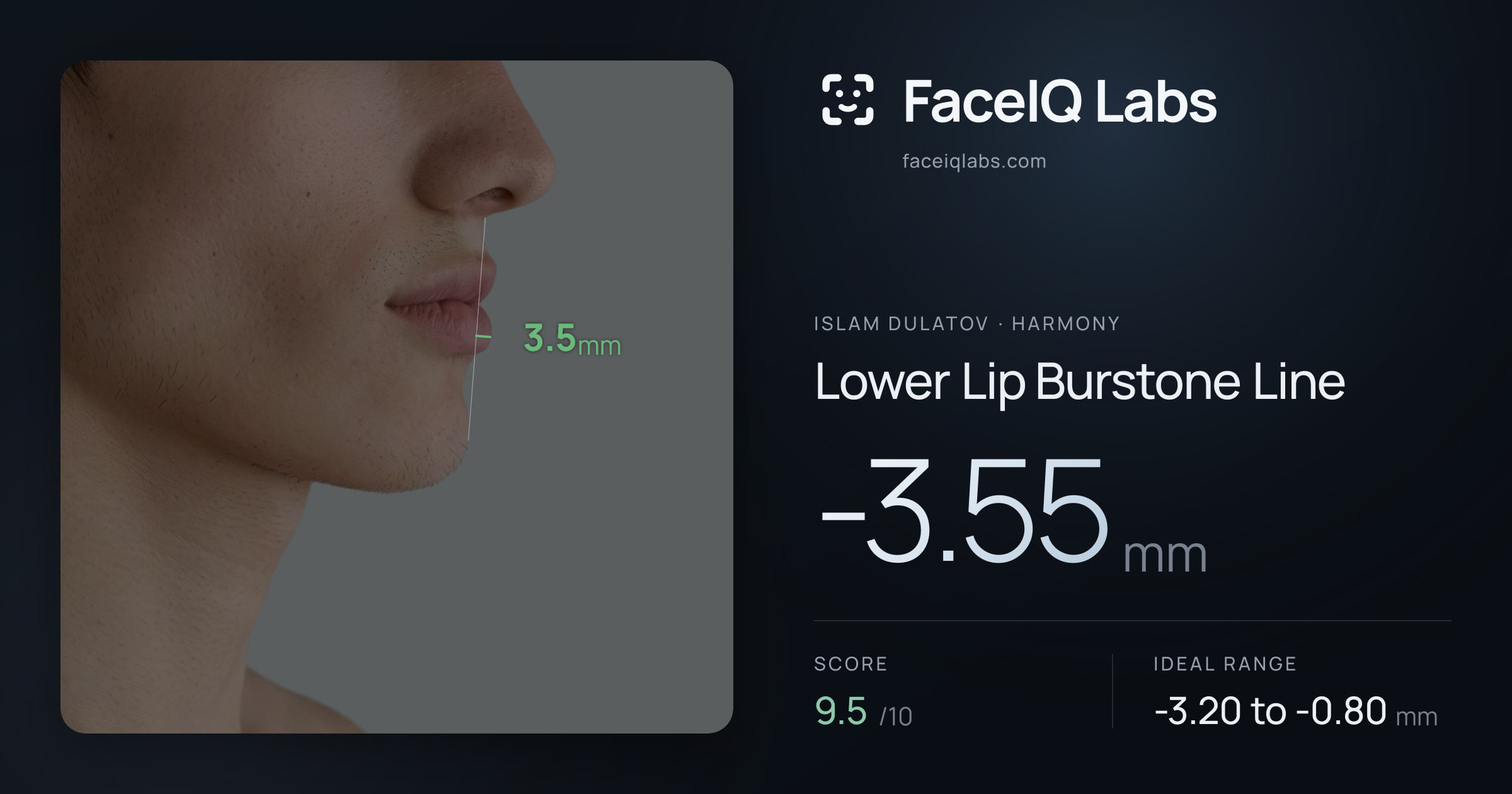 Islam Dulatov Lower Lip Burstone Line: -3.55mm, drawn on the photo