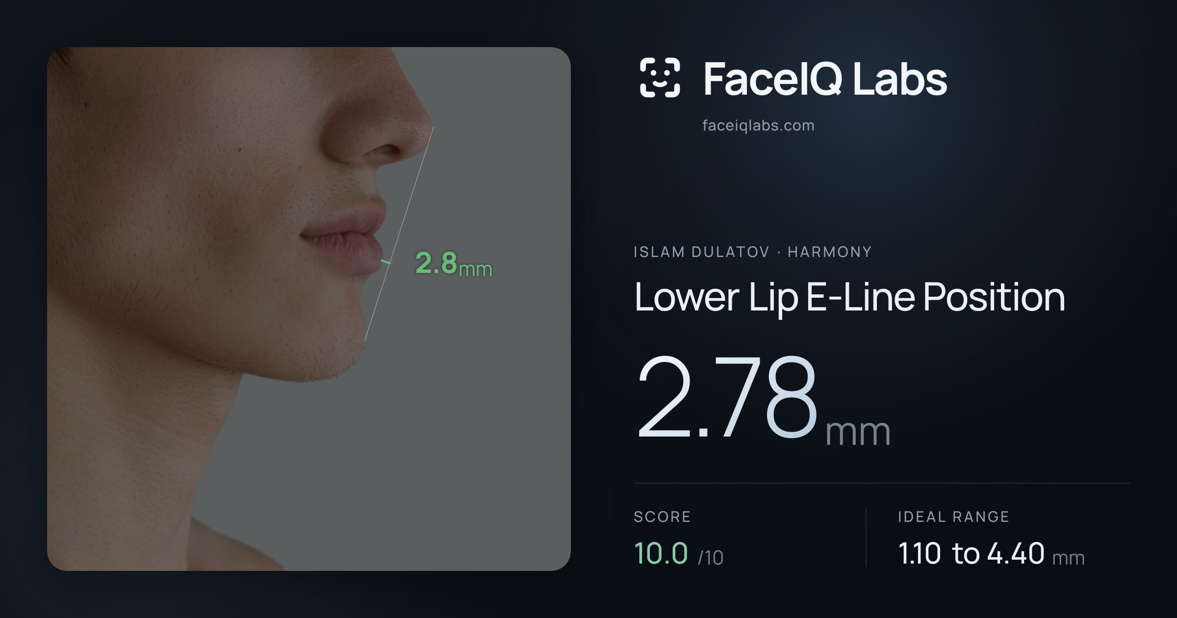 Islam Dulatov Lower Lip E-Line Position: 2.78mm, drawn on the photo