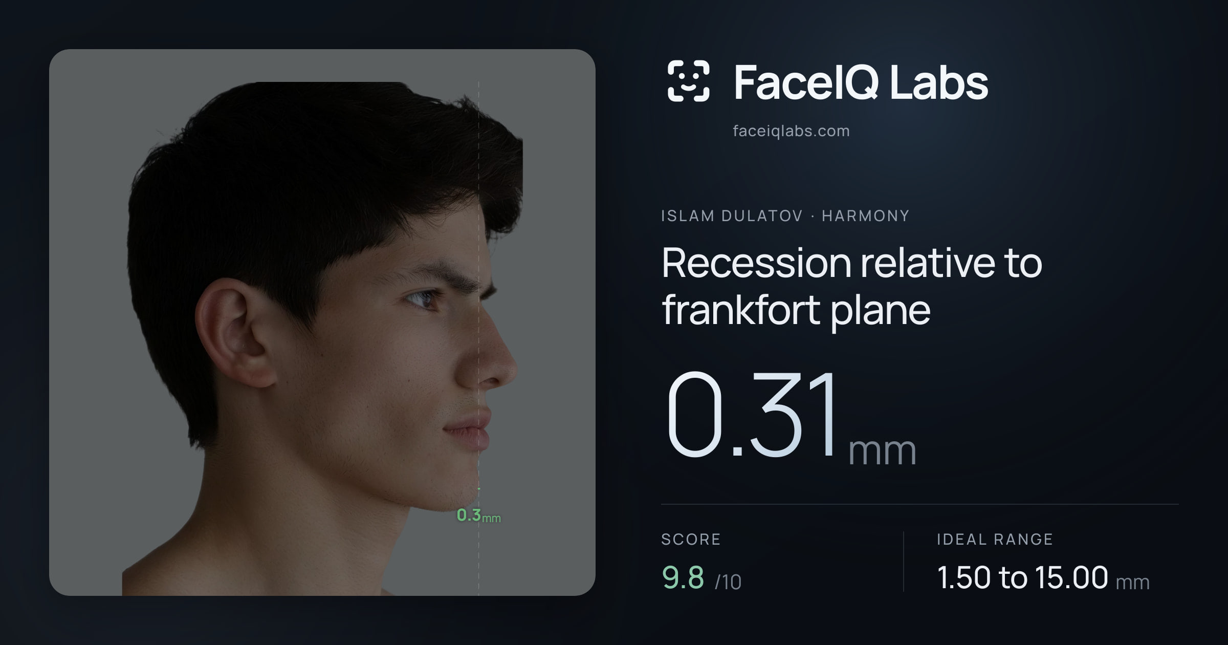 Islam Dulatov Recession relative to frankfort plane: 0.31mm, drawn on the photo
