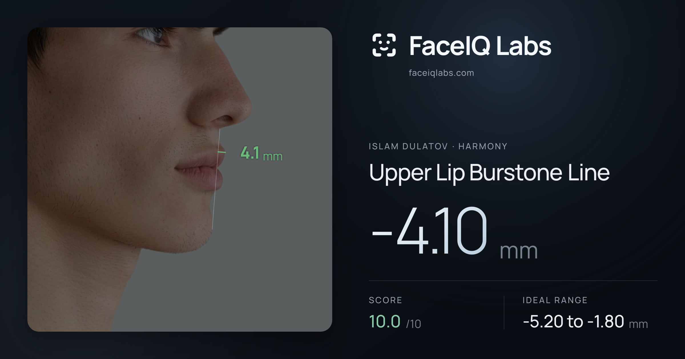 Islam Dulatov Upper Lip Burstone Line: -4.10mm, drawn on the photo