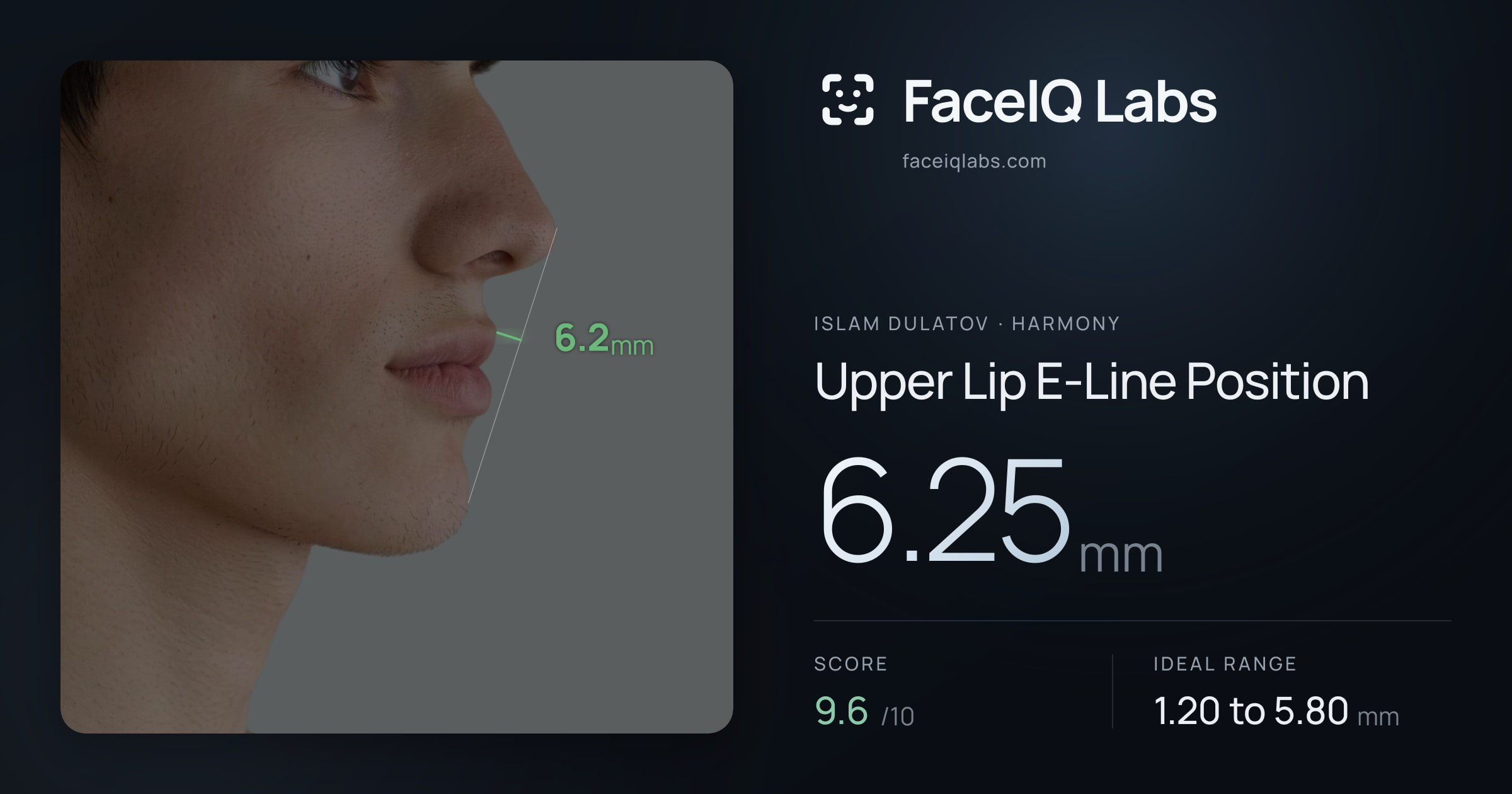 Islam Dulatov Upper Lip E-Line Position: 6.25mm, drawn on the photo