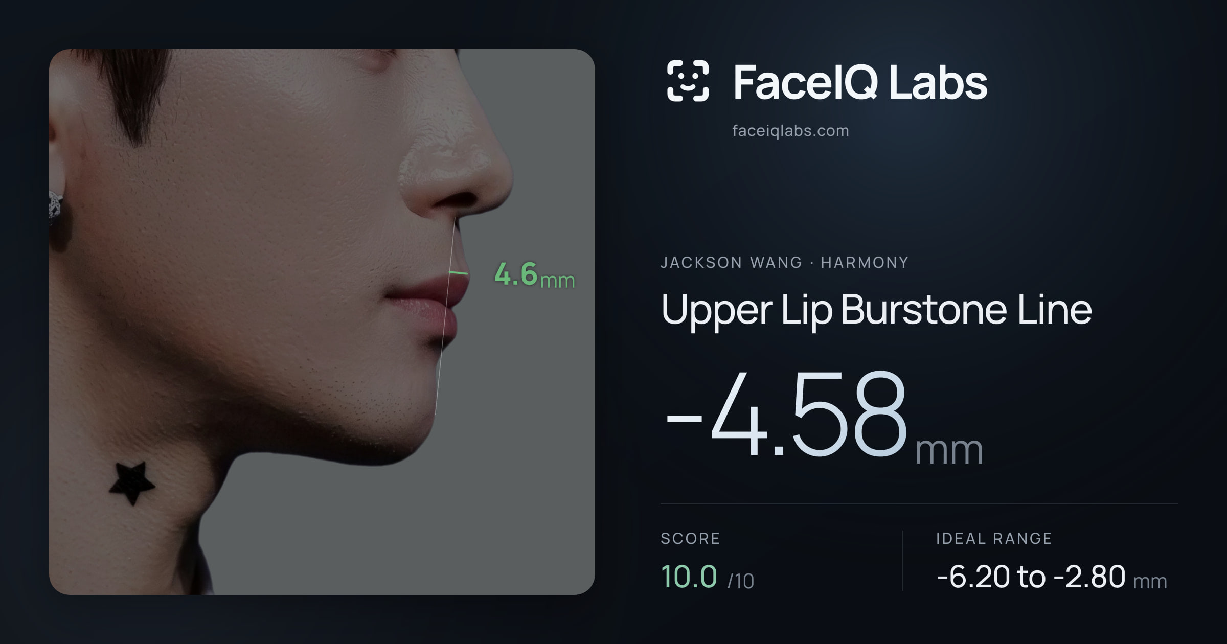 Jackson Wang Upper Lip Burstone Line: -4.58mm, drawn on the photo