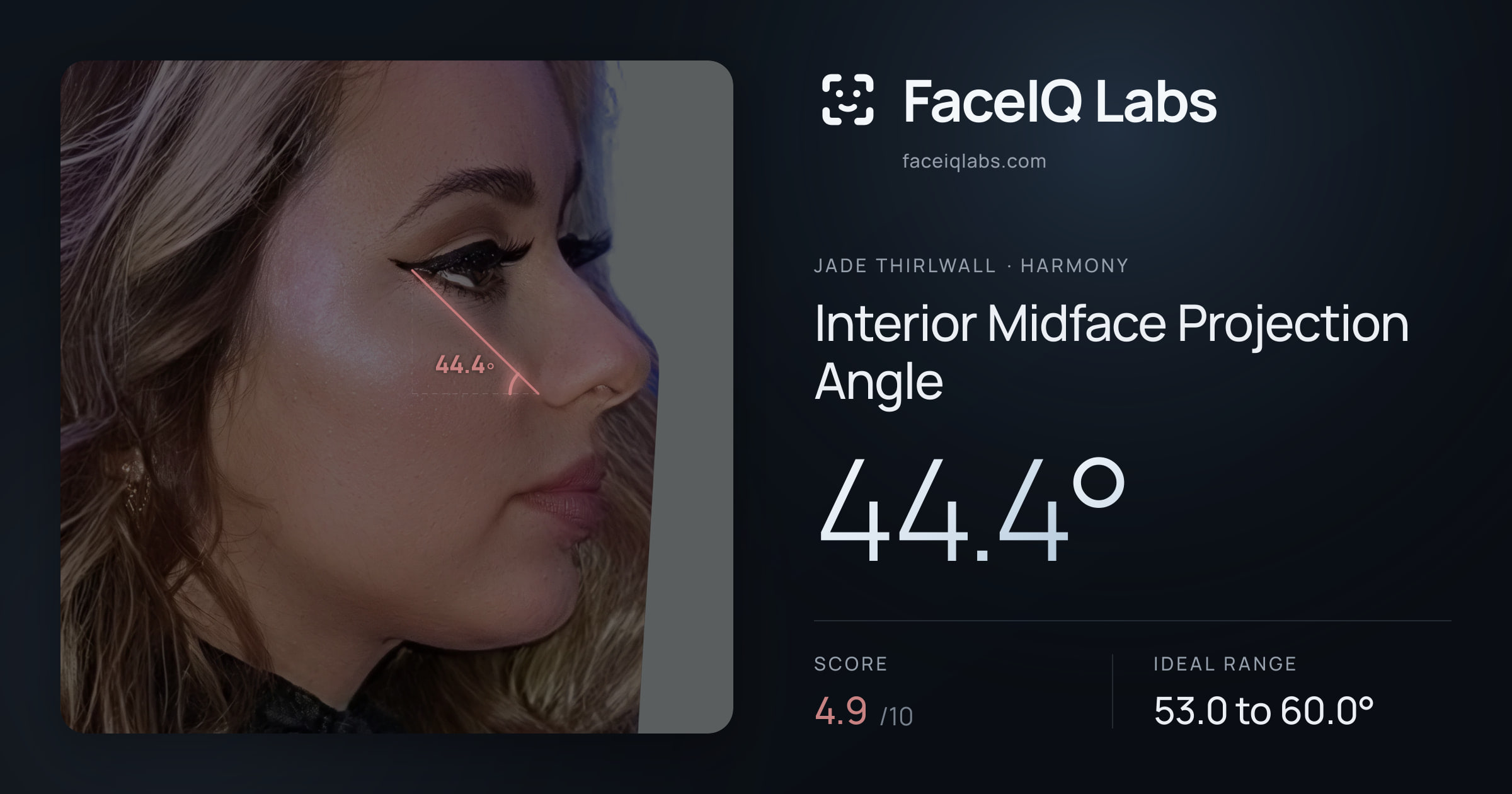Jade Thirlwall Interior Midface Projection Angle: 44.4°, drawn on the photo