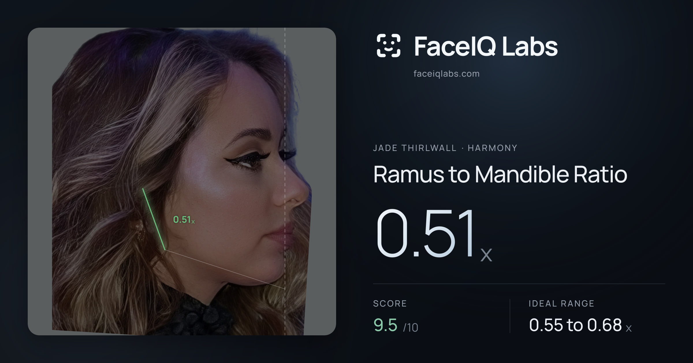 Jade Thirlwall Ramus to Mandible Ratio: 0.51x, drawn on the photo