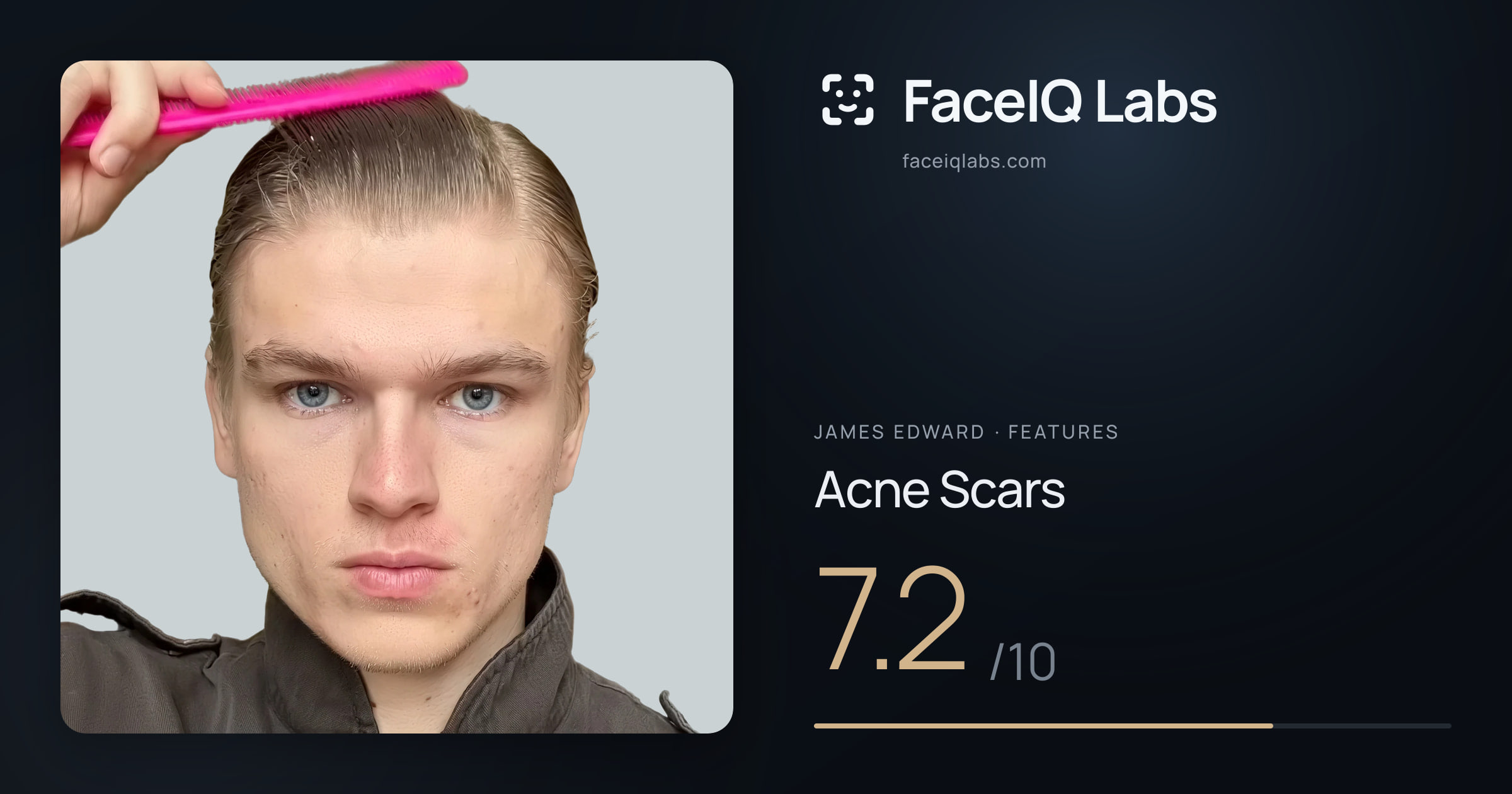 James Edward Acne Scars: 7.2/10, drawn on the photo