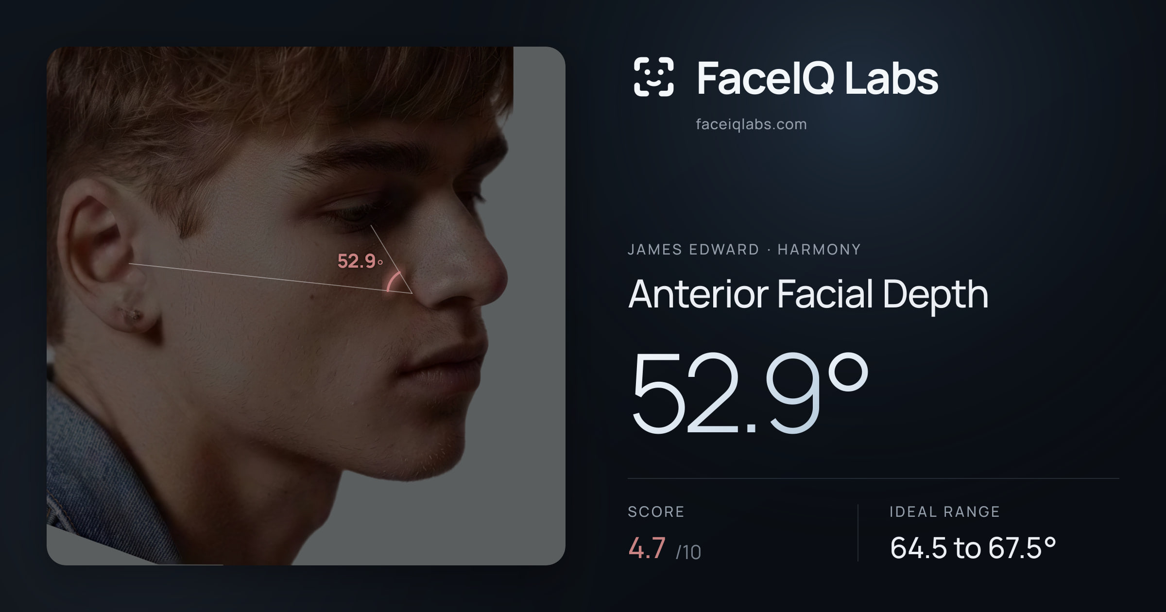 James Edward Anterior Facial Depth: 52.9°, drawn on the photo