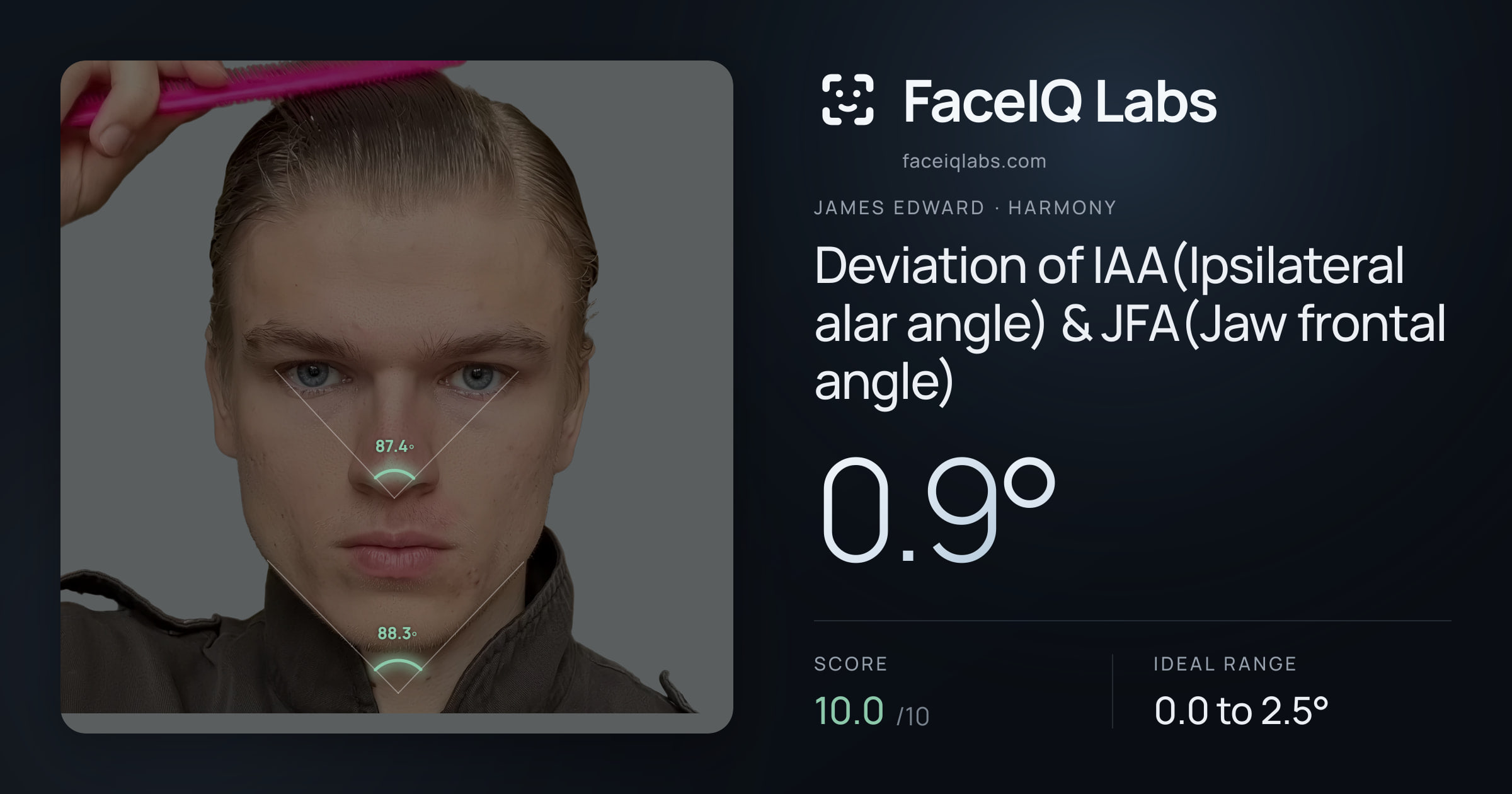 James Edward Deviation of IAA(Ipsilateral alar angle) & JFA(Jaw frontal angle): 0.9°, drawn on the photo