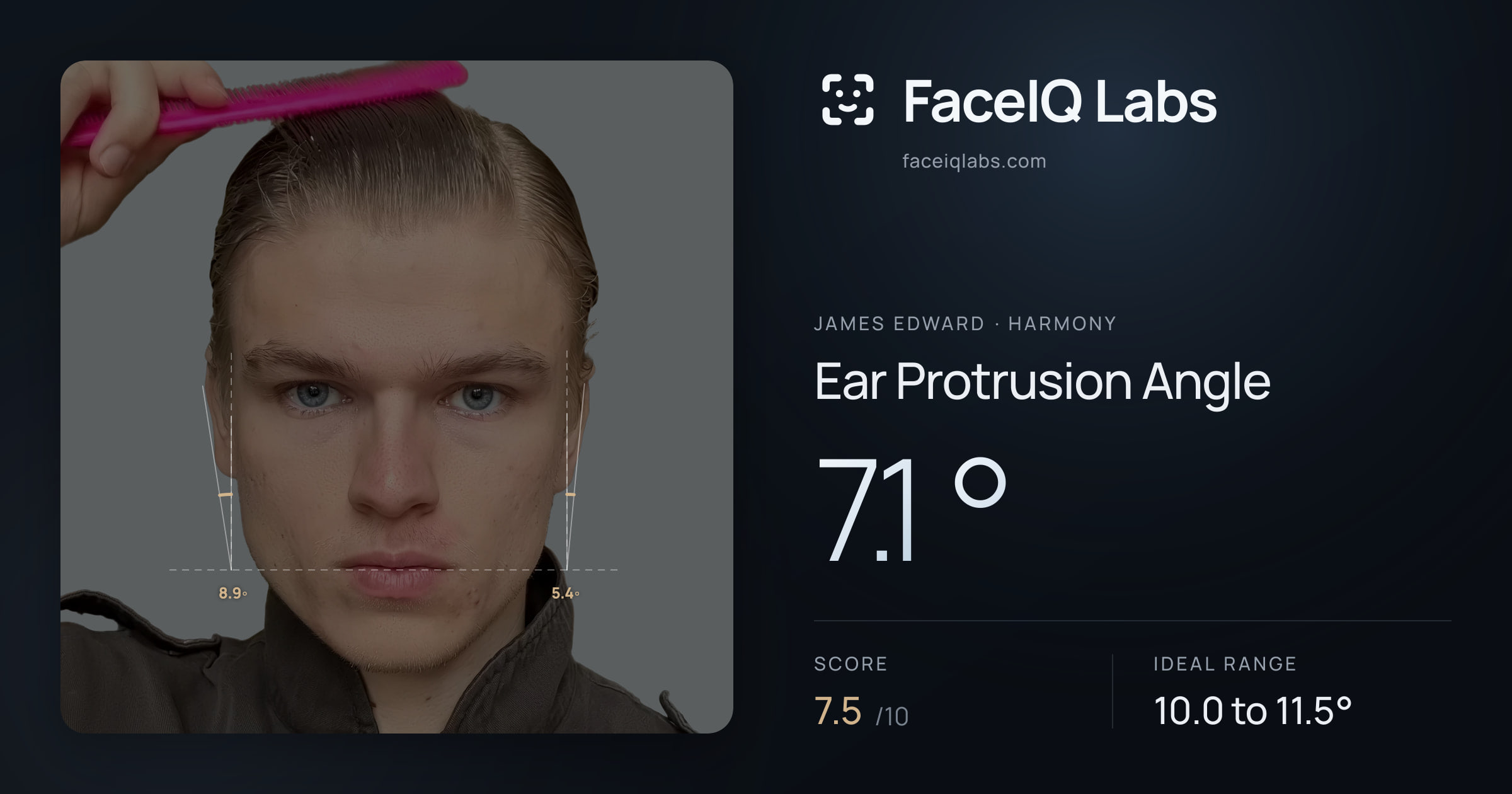 James Edward Ear Protrusion Angle: 7.1°, drawn on the photo