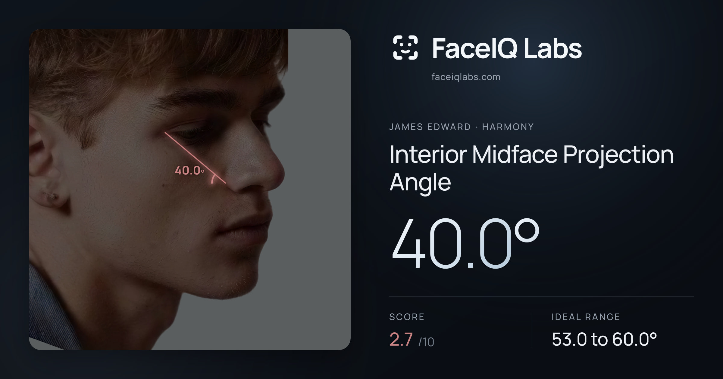 James Edward Interior Midface Projection Angle: 40.0°, drawn on the photo