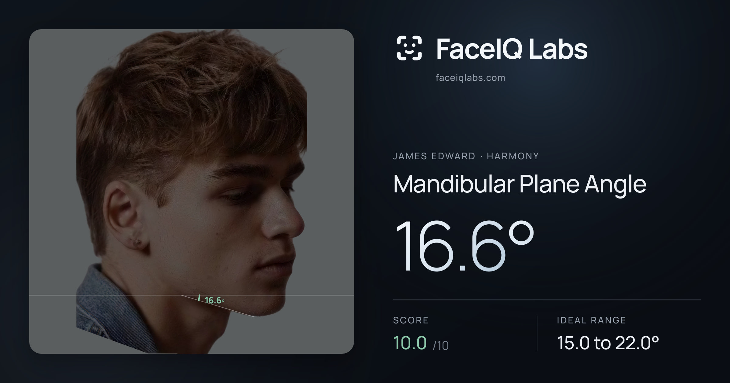 James Edward Mandibular Plane Angle: 16.6°, drawn on the photo