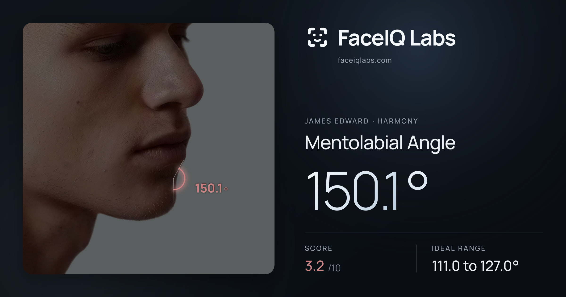 James Edward Mentolabial Angle: 150.1°, drawn on the photo