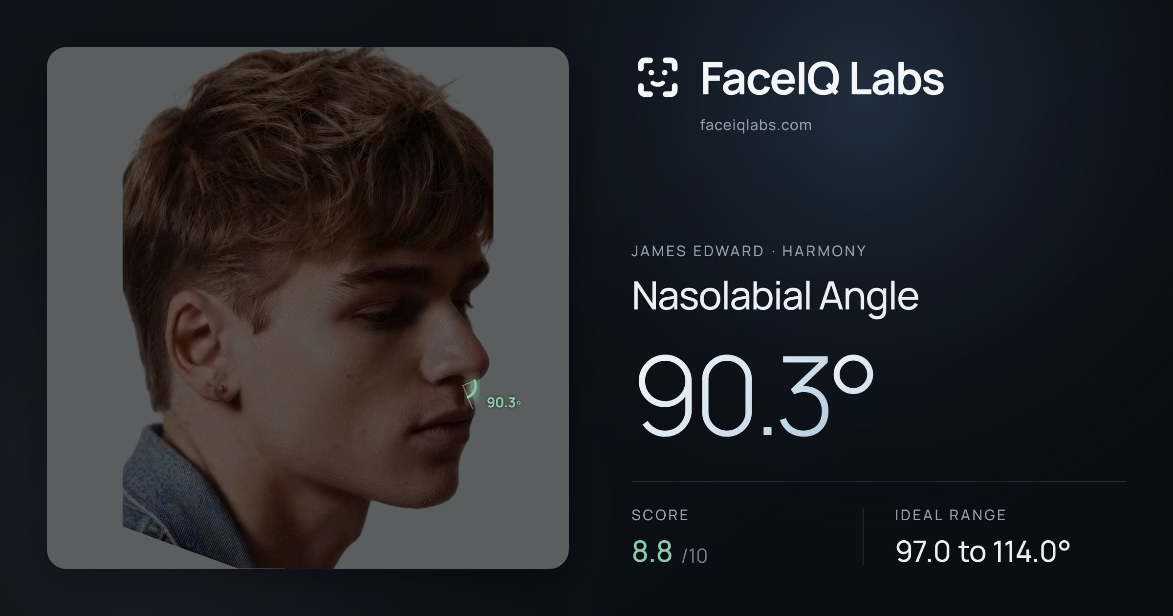 James Edward Nasolabial Angle: 90.3°, drawn on the photo
