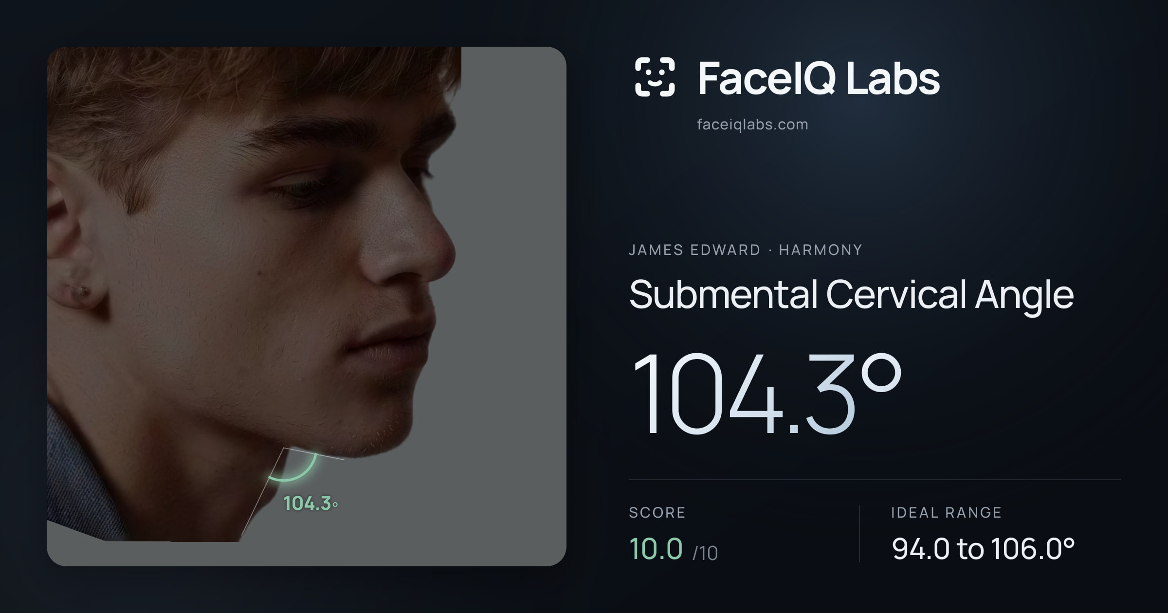 James Edward Submental Cervical Angle: 104.3°, drawn on the photo