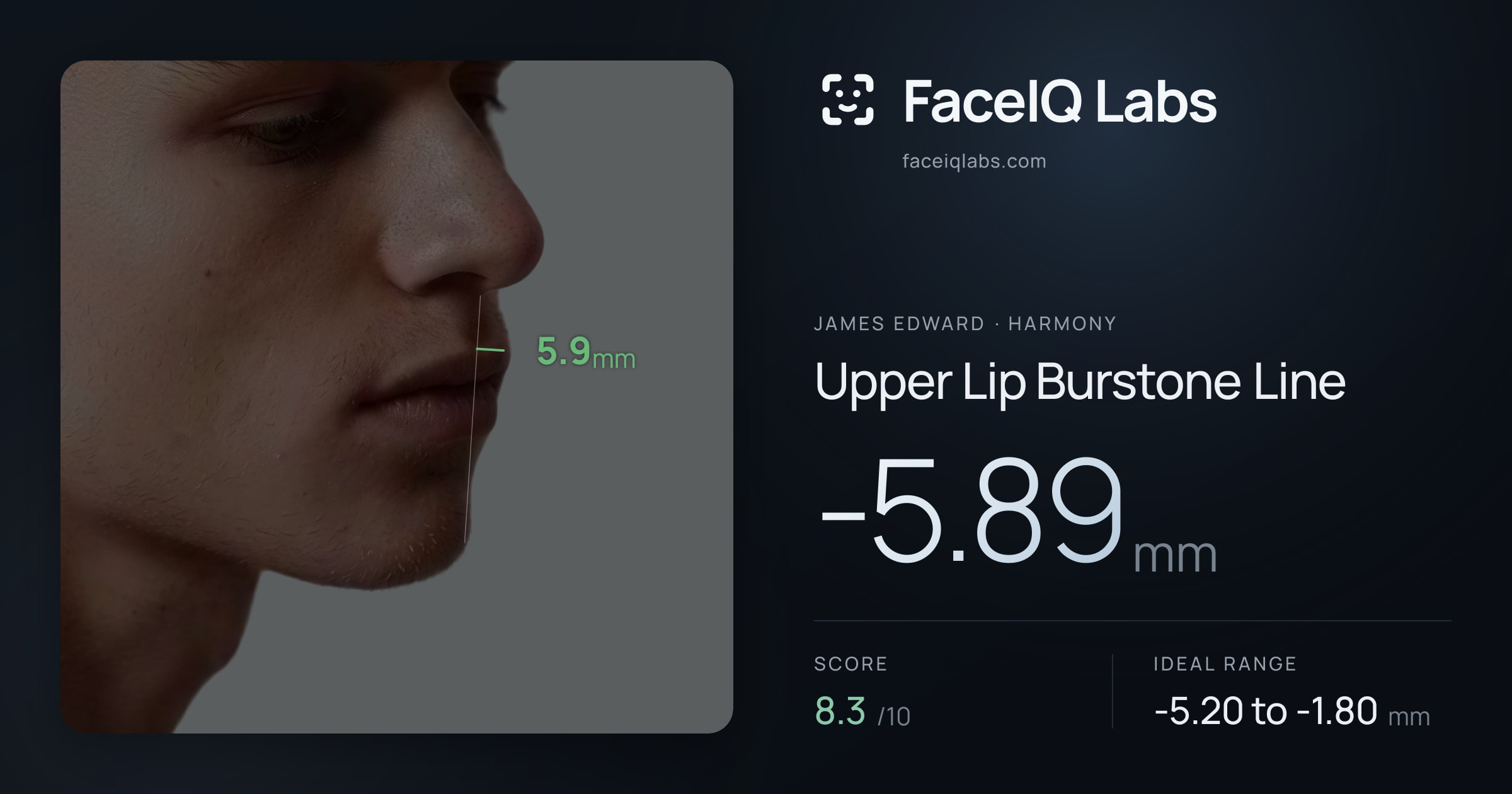 James Edward Upper Lip Burstone Line: -5.89mm, drawn on the photo