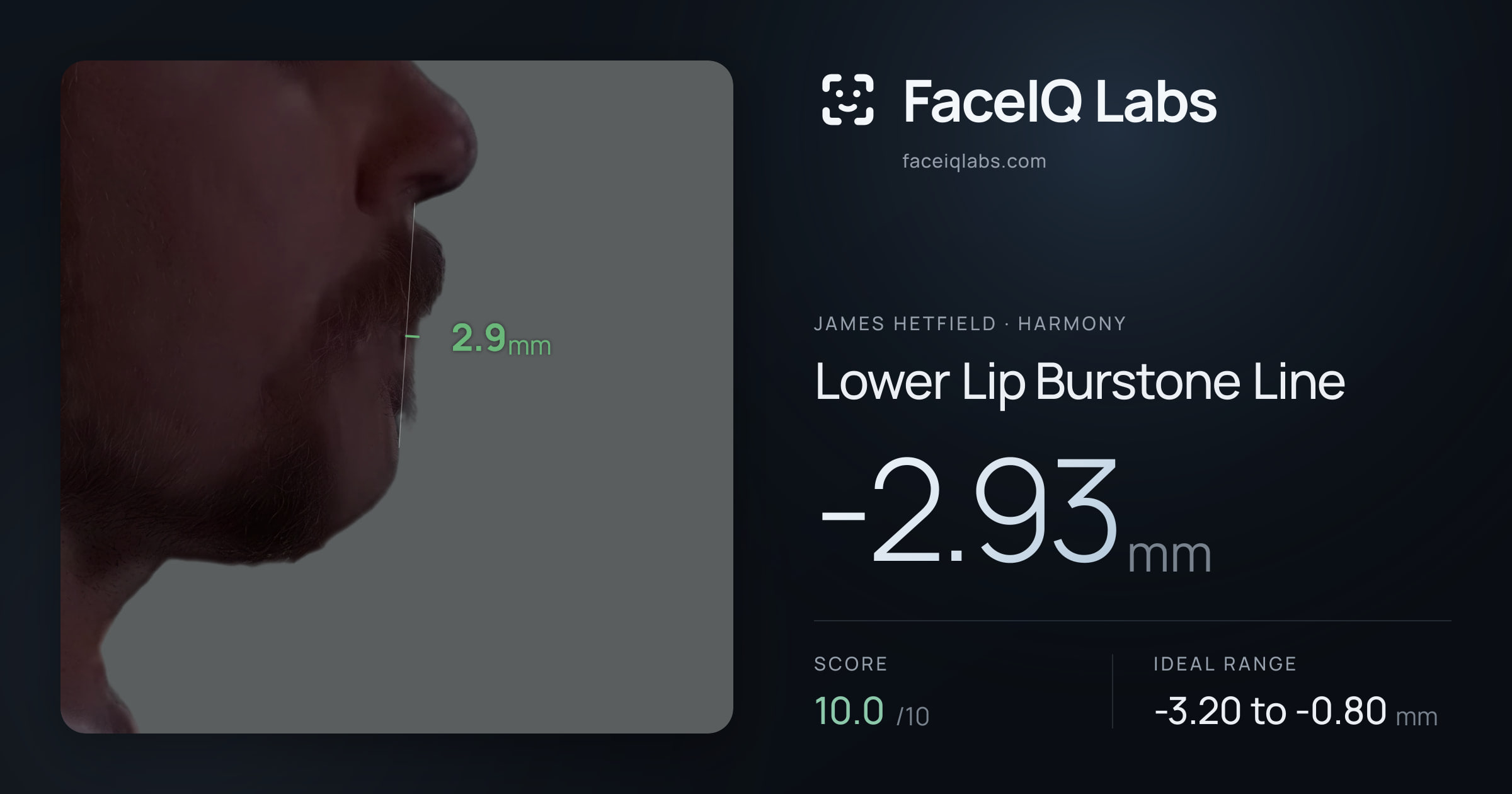 James Hetfield Lower Lip Burstone Line: -2.93mm, drawn on the photo