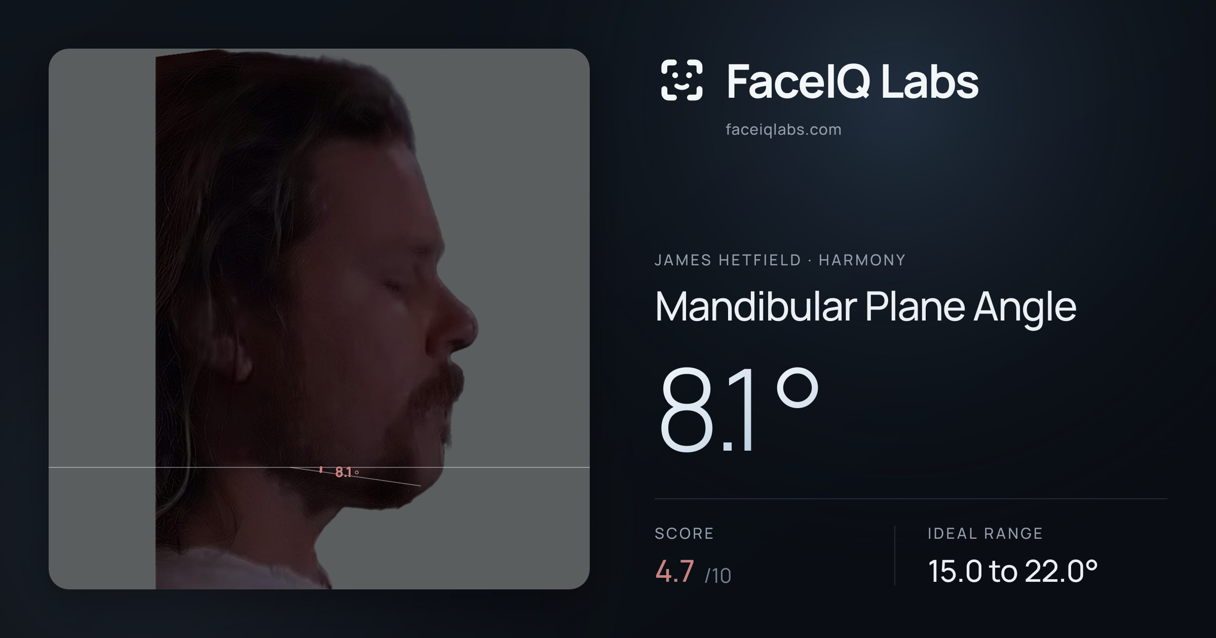 James Hetfield Mandibular Plane Angle: 8.1°, drawn on the photo