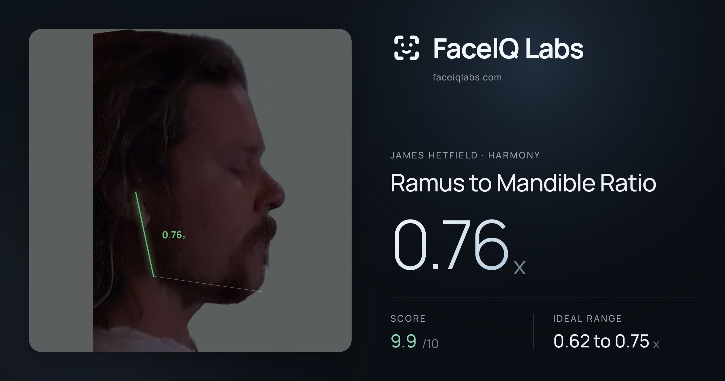 James Hetfield Ramus to Mandible Ratio: 0.76x, drawn on the photo