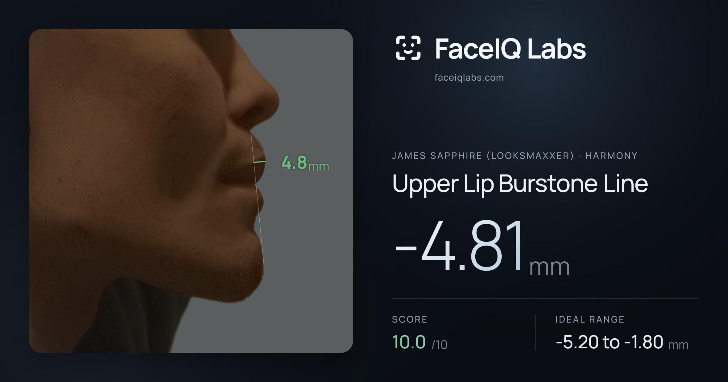 James Sapphire (Looksmaxxer) Upper Lip Burstone Line: -4.81mm, drawn on the photo