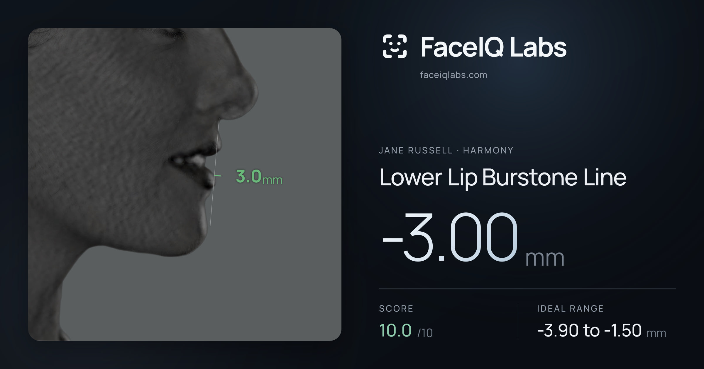 Jane Russell Lower Lip Burstone Line: -3.00mm, drawn on the photo