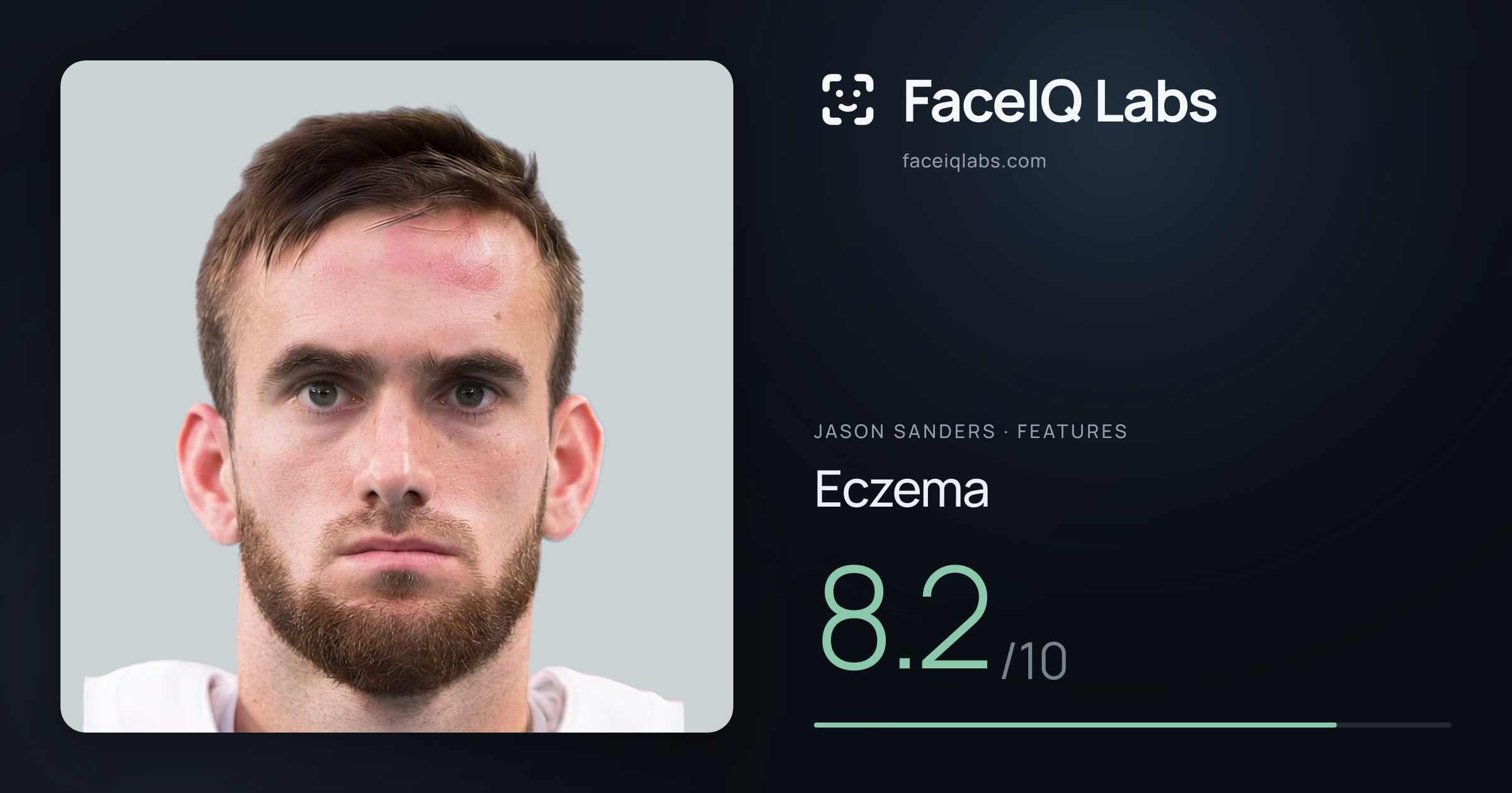 Jason Sanders Eczema: 8.2/10, drawn on the photo