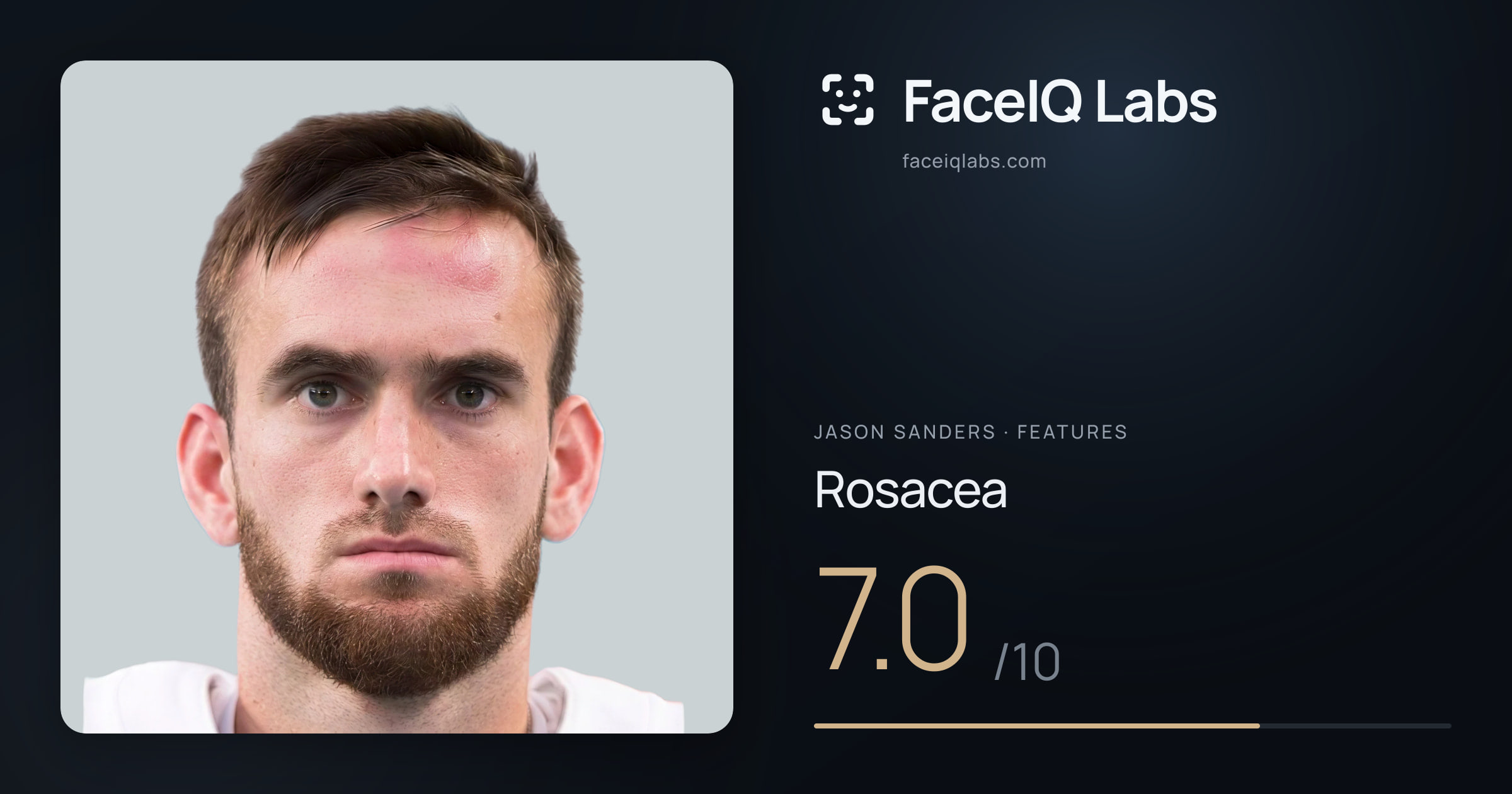 Jason Sanders Rosacea: 7.0/10, drawn on the photo