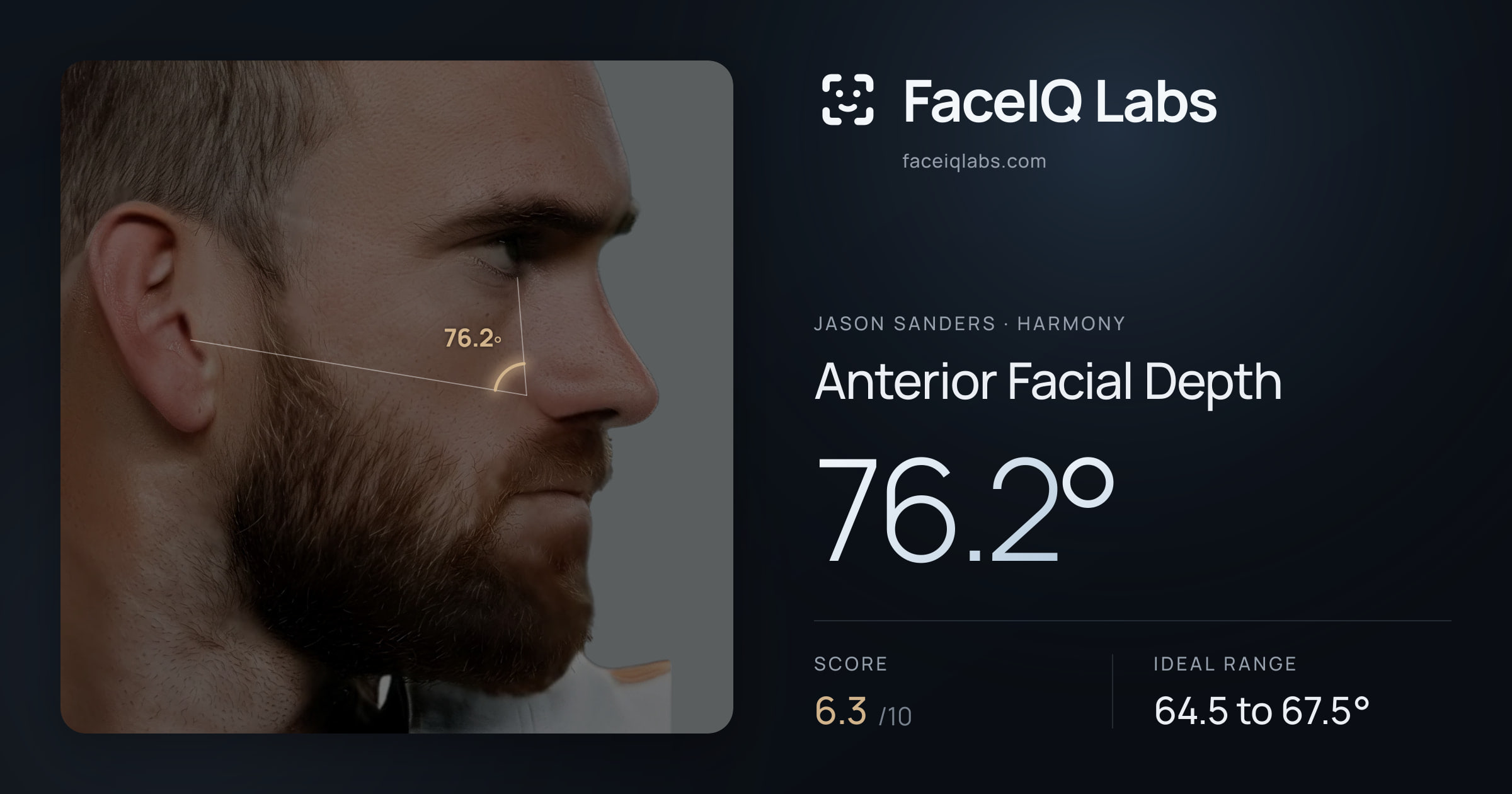 Jason Sanders Anterior Facial Depth: 76.2°, drawn on the photo