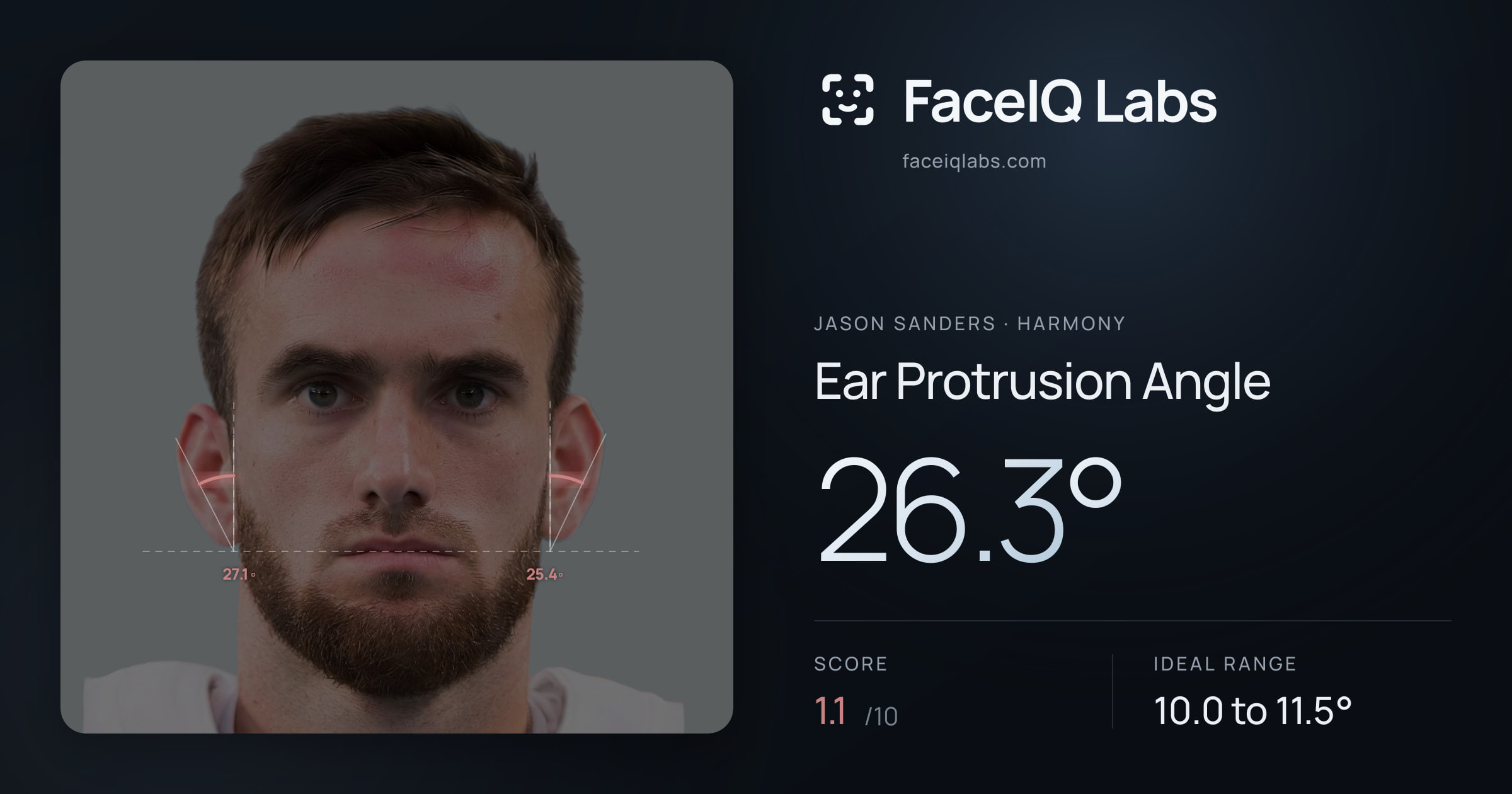 Jason Sanders Ear Protrusion Angle: 26.3°, drawn on the photo
