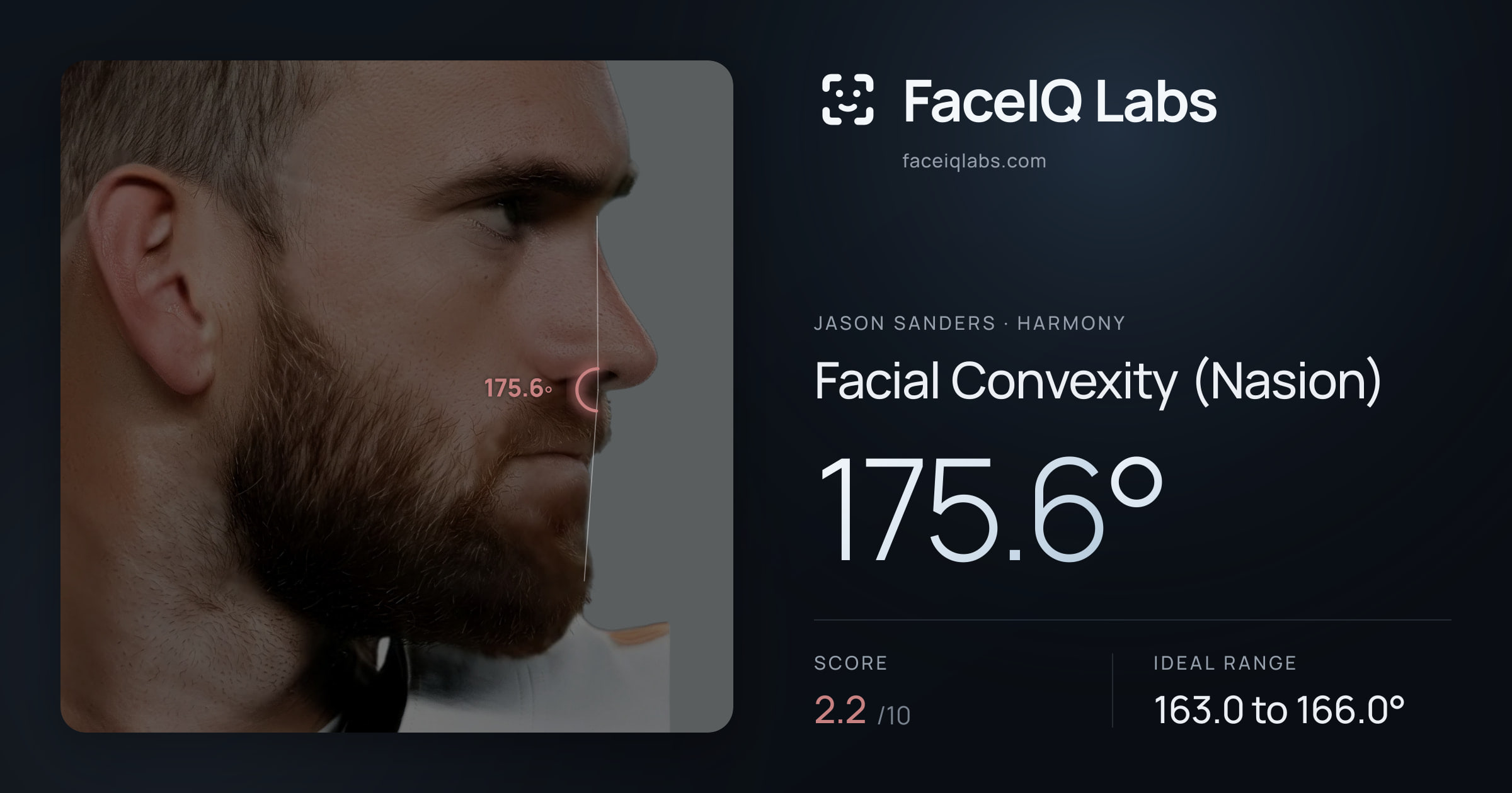 Jason Sanders Facial Convexity (Nasion): 175.6°, drawn on the photo