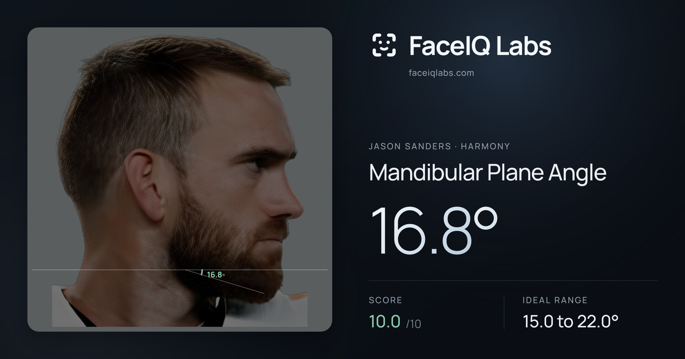 Jason Sanders Mandibular Plane Angle: 16.8°, drawn on the photo