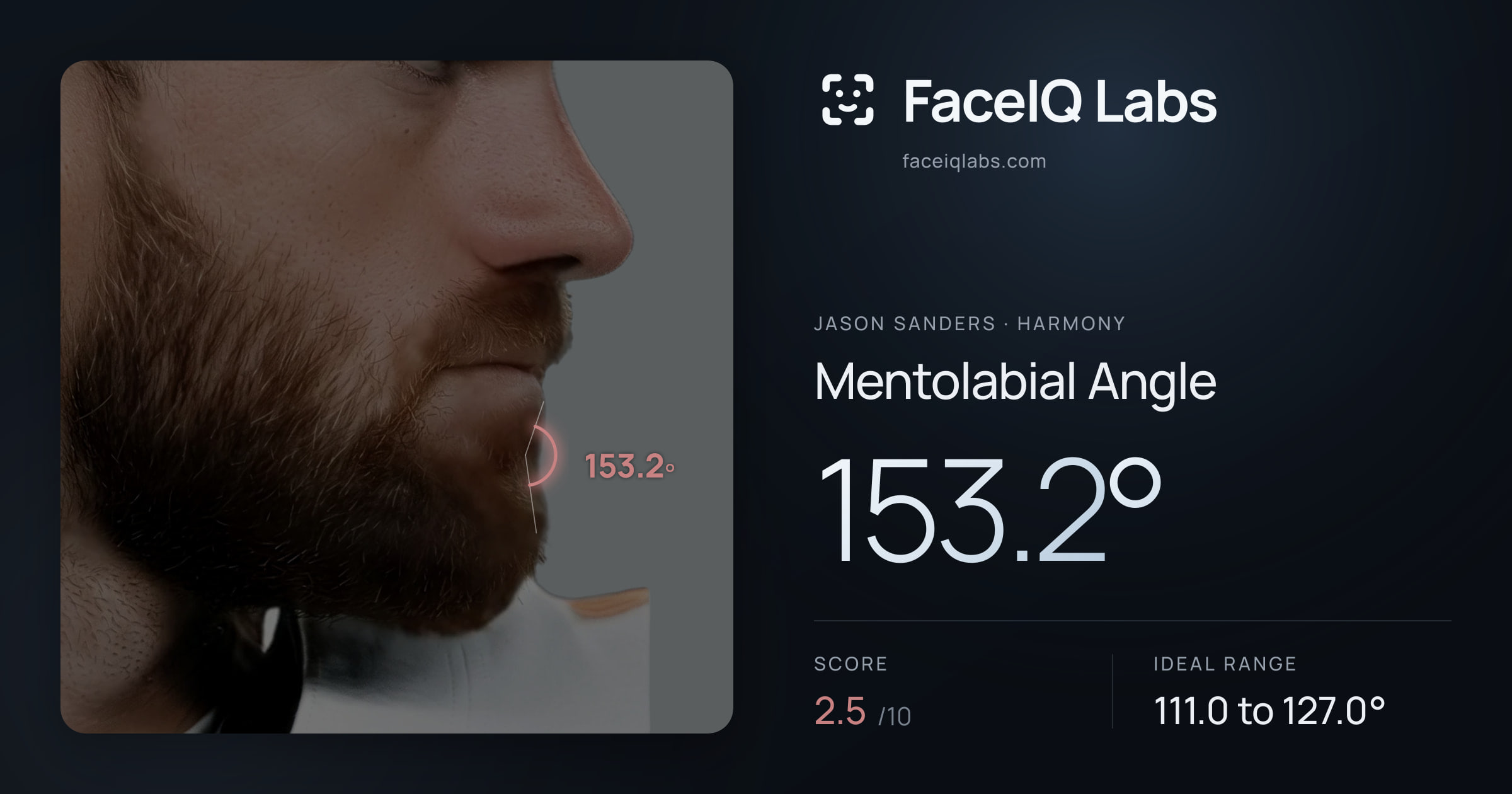 Jason Sanders Mentolabial Angle: 153.2°, drawn on the photo