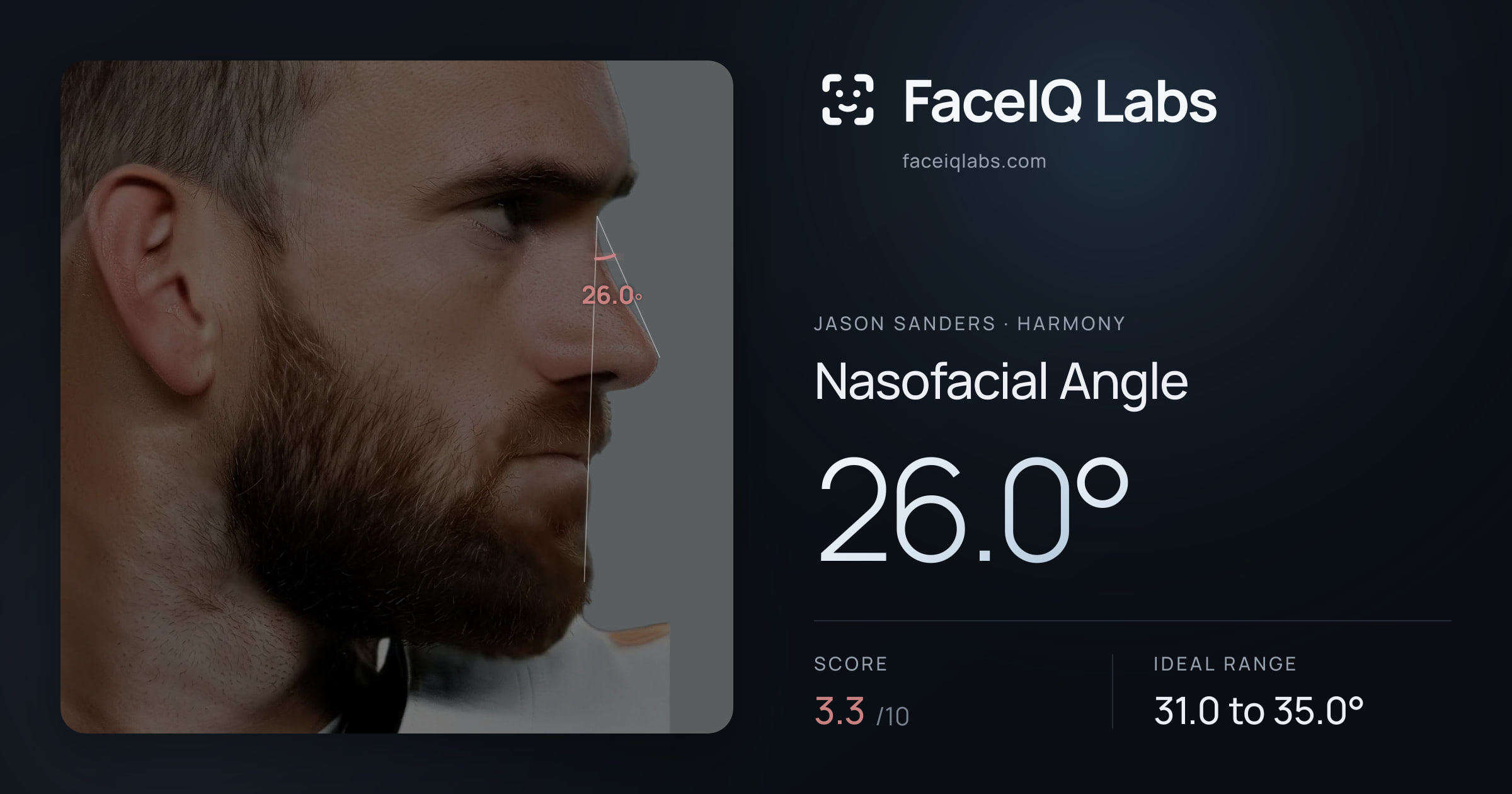 Jason Sanders Nasofacial Angle: 26.0°, drawn on the photo