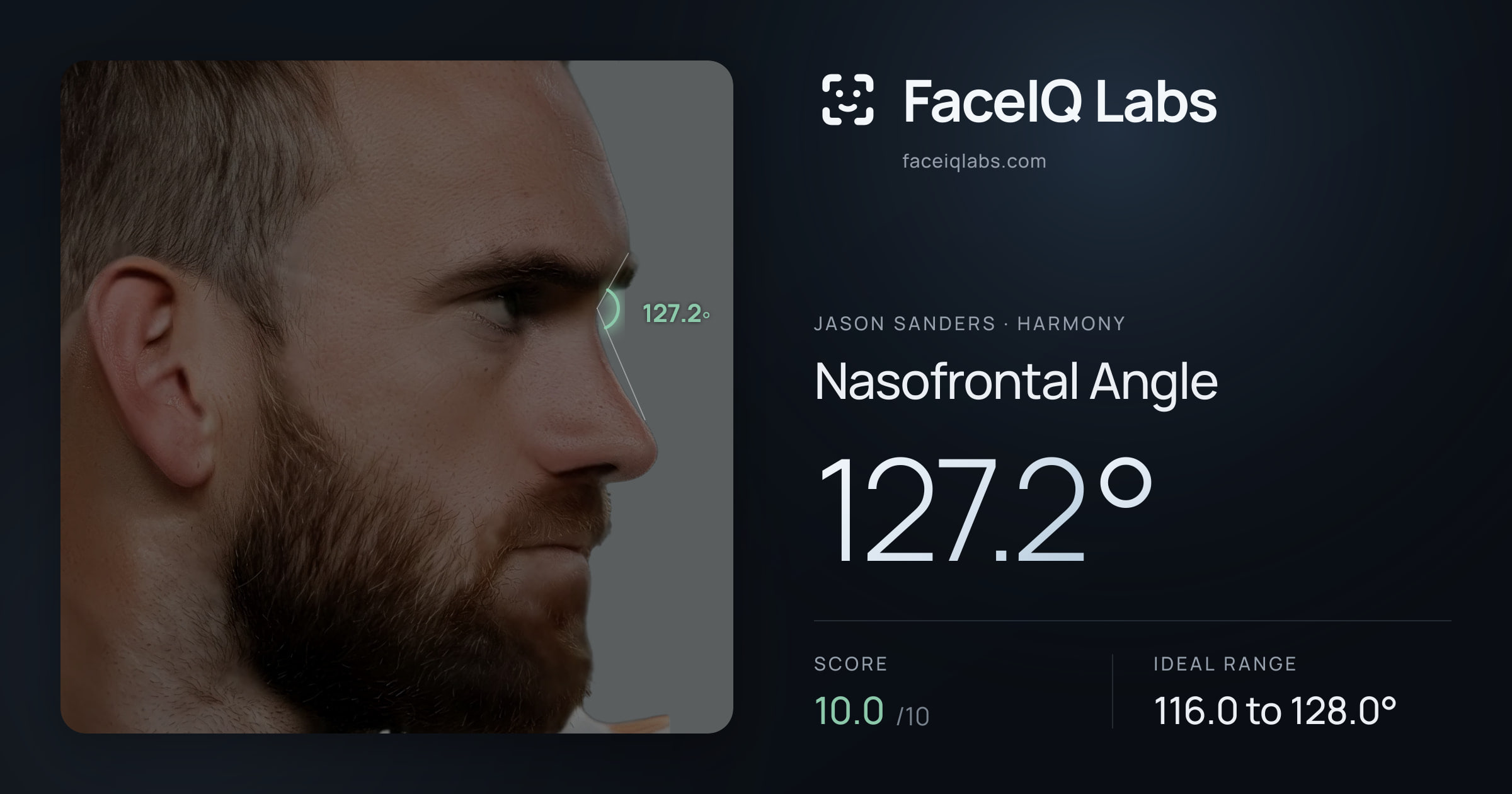 Jason Sanders Nasofrontal Angle: 127.2°, drawn on the photo
