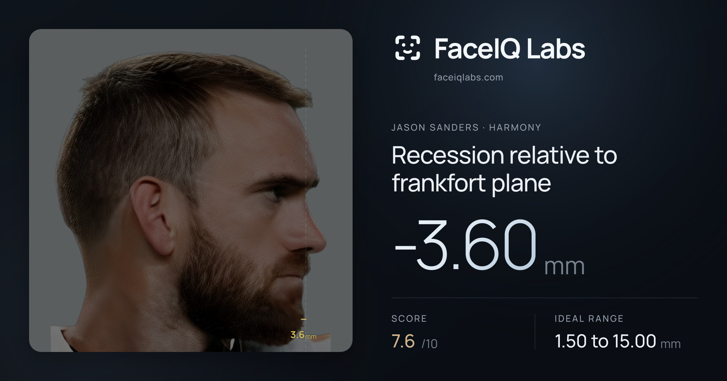 Jason Sanders Recession relative to frankfort plane: -3.60mm, drawn on the photo