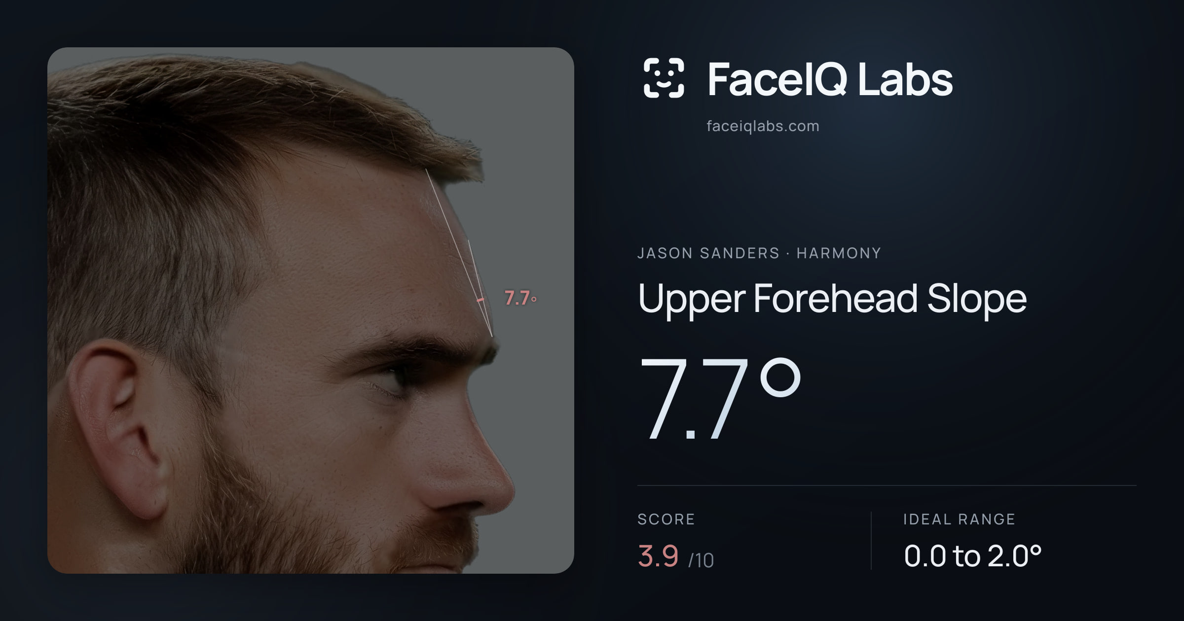 Jason Sanders Upper Forehead Slope: 7.7°, drawn on the photo