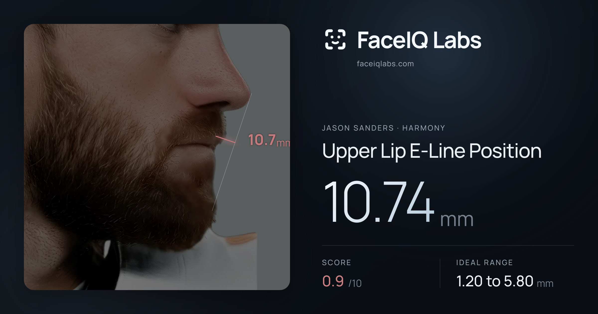 Jason Sanders Upper Lip E-Line Position: 10.74mm, drawn on the photo