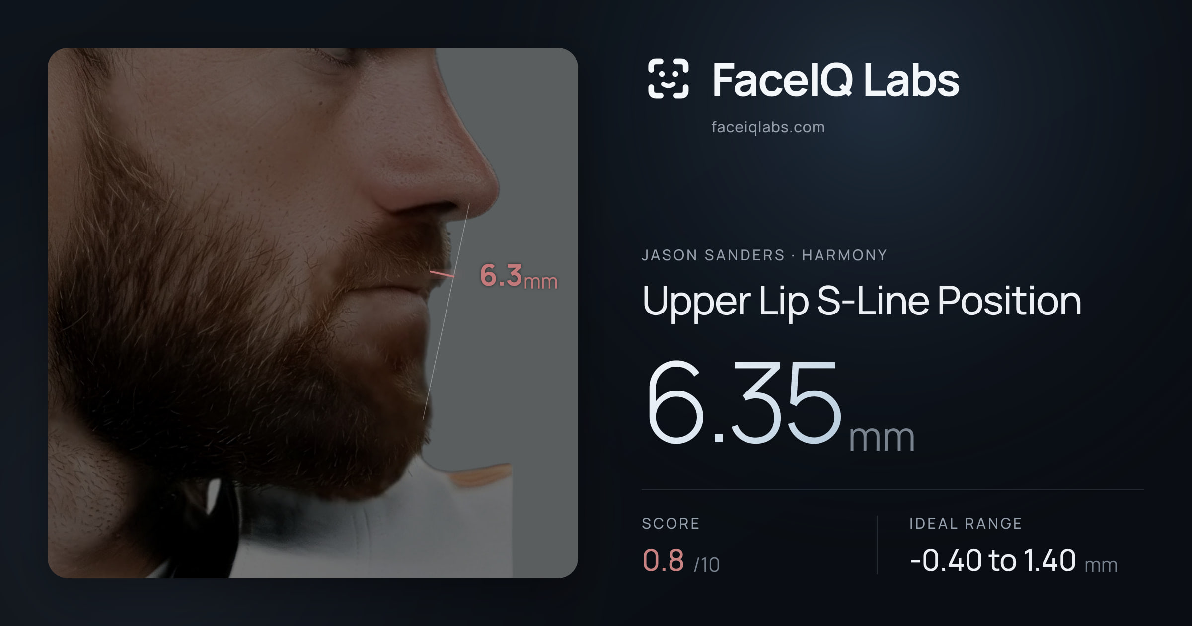 Jason Sanders Upper Lip S-Line Position: 6.35mm, drawn on the photo