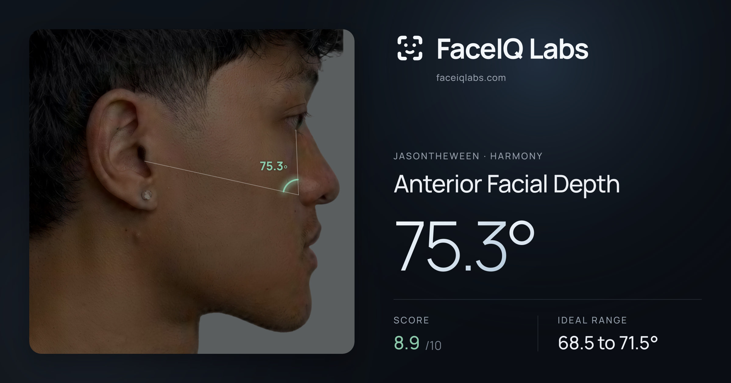 Jasontheween Anterior Facial Depth: 75.3°, drawn on the photo