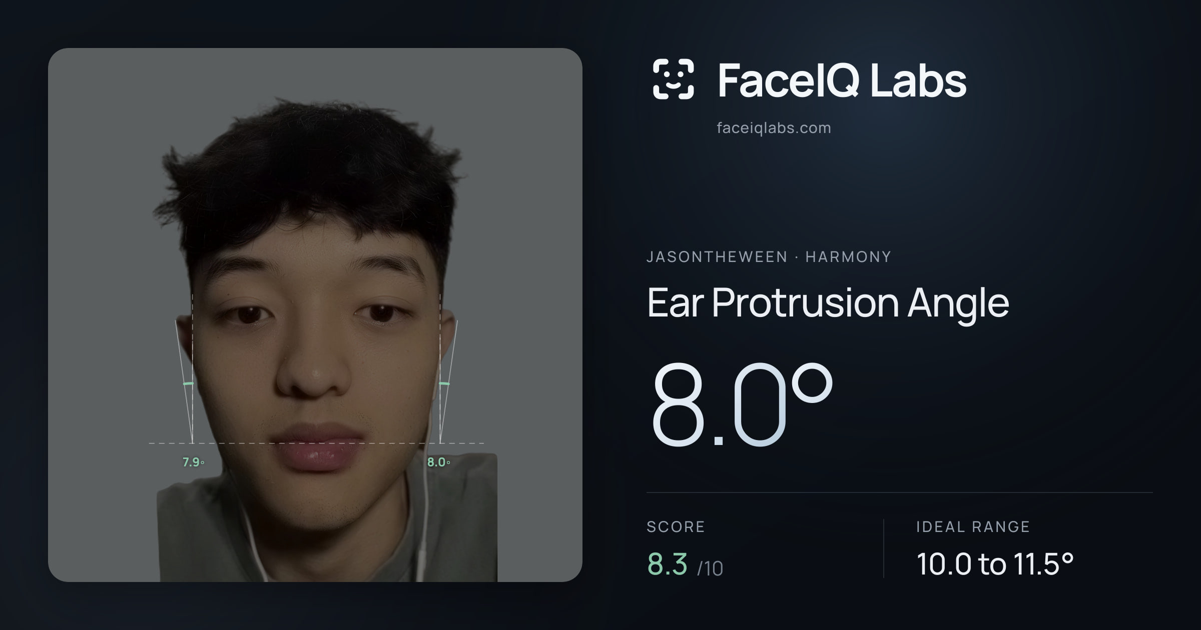 Jasontheween Ear Protrusion Angle: 8.0°, drawn on the photo