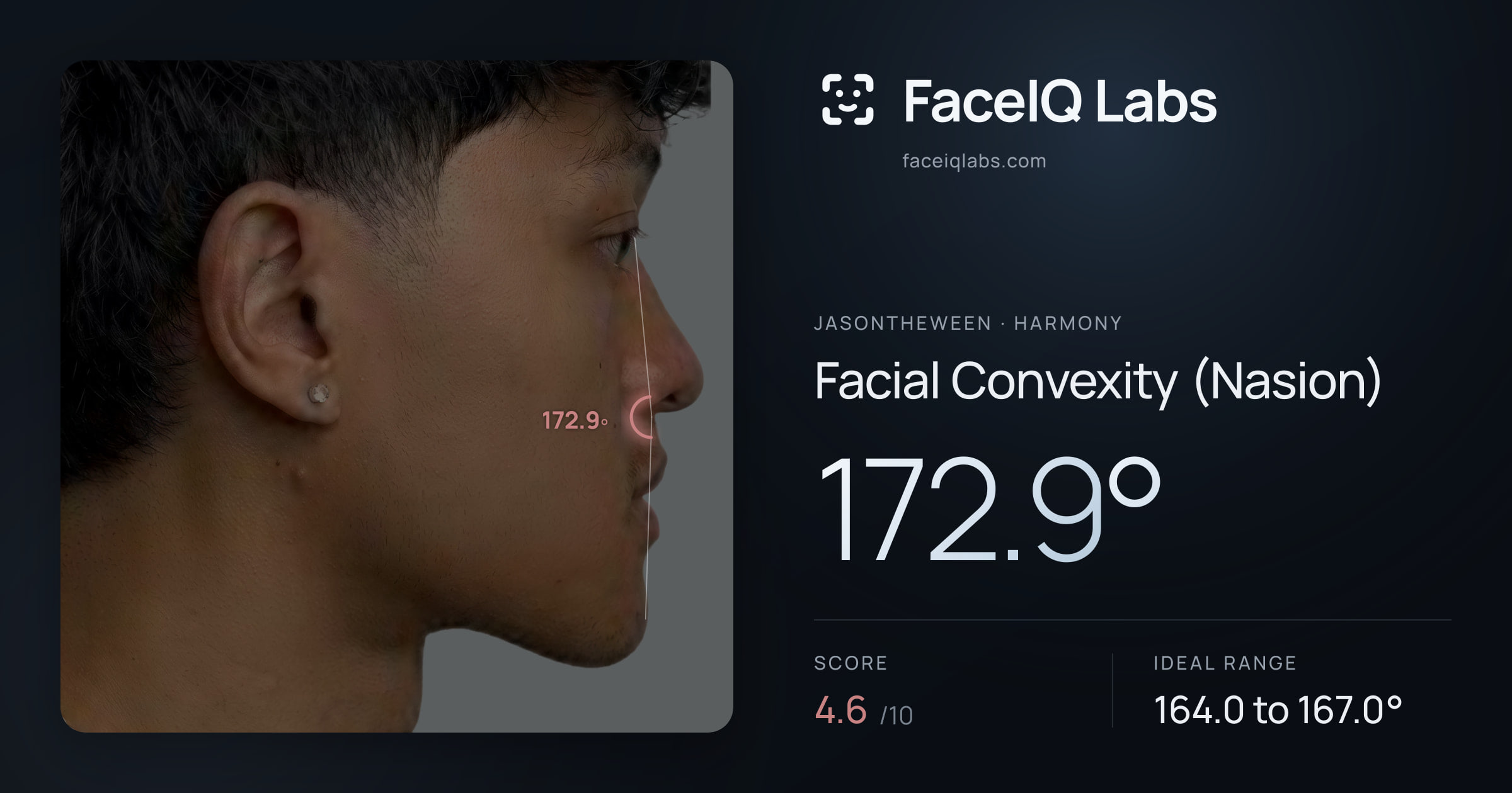Jasontheween Facial Convexity (Nasion): 172.9°, drawn on the photo