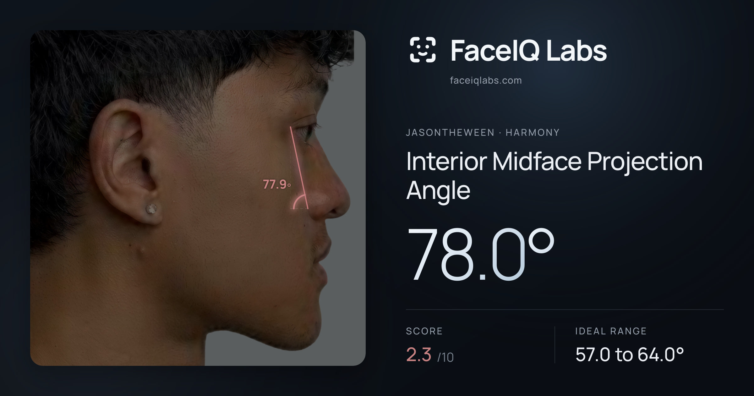 Jasontheween Interior Midface Projection Angle: 78.0°, drawn on the photo