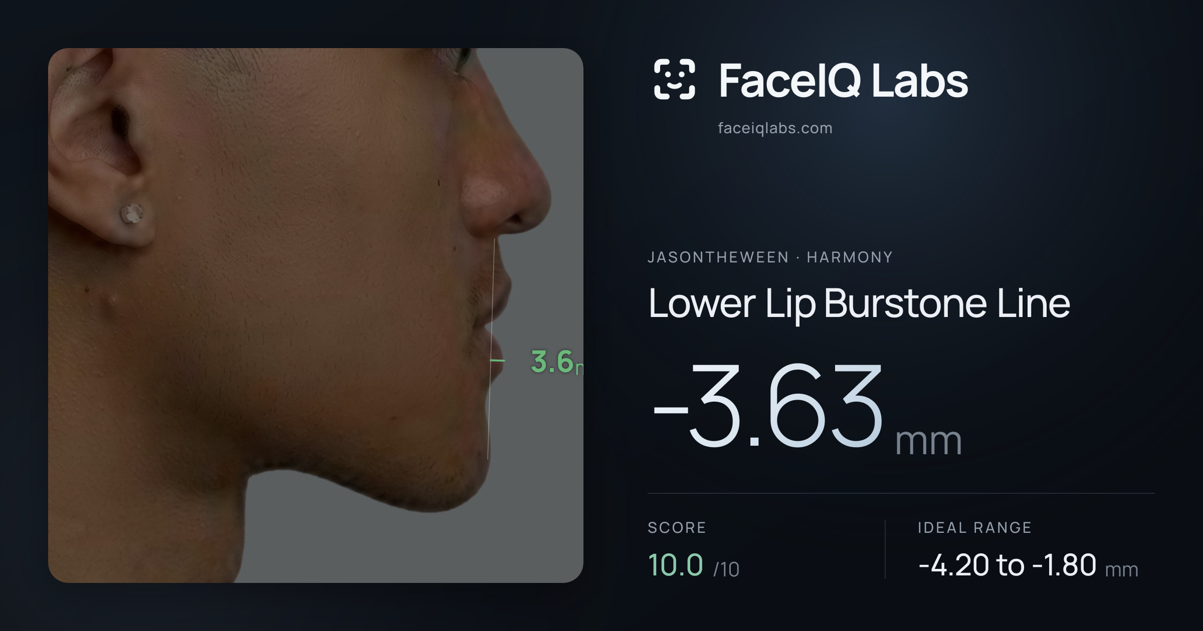 Jasontheween Lower Lip Burstone Line: -3.63mm, drawn on the photo