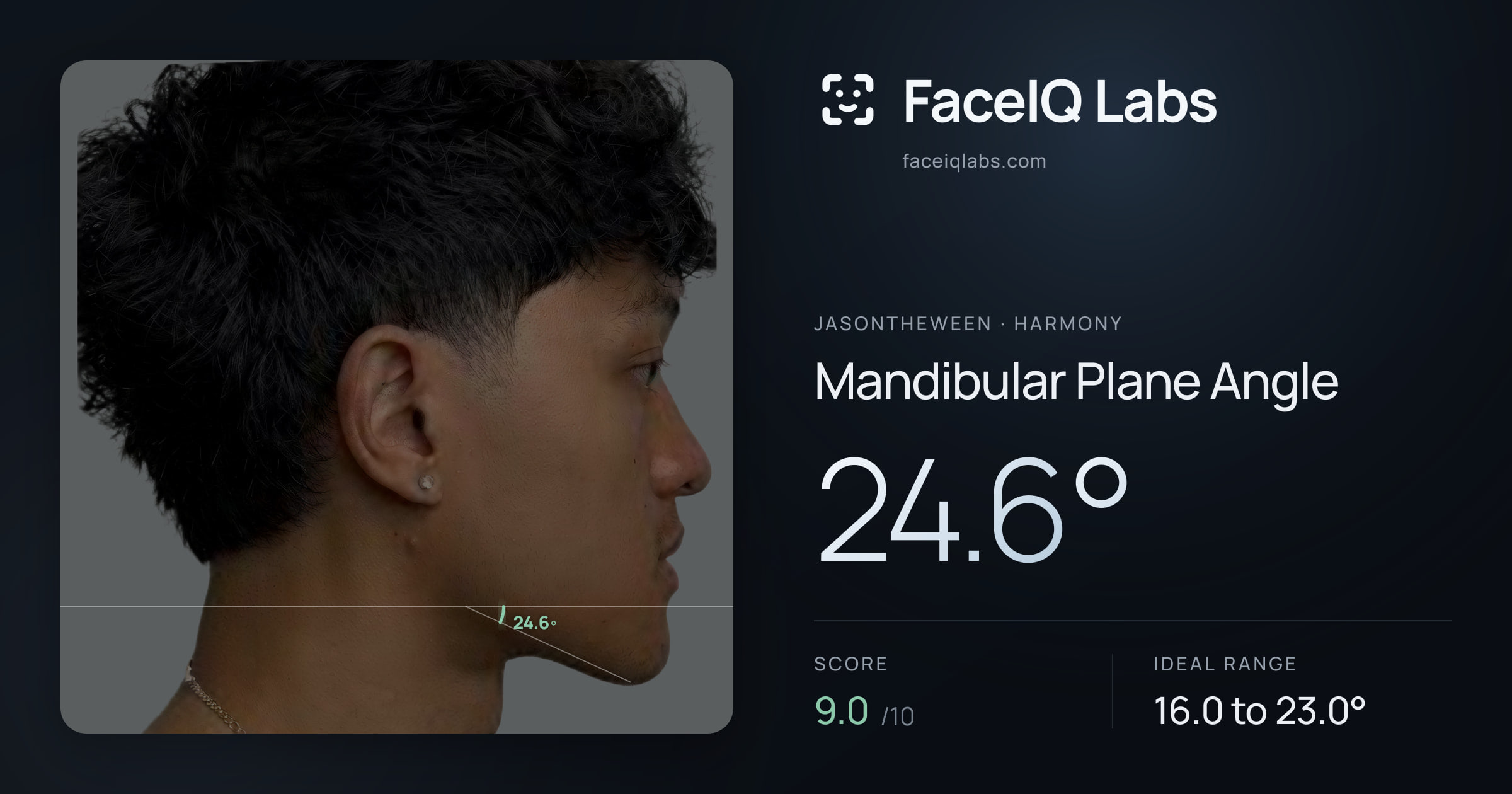 Jasontheween Mandibular Plane Angle: 24.6°, drawn on the photo
